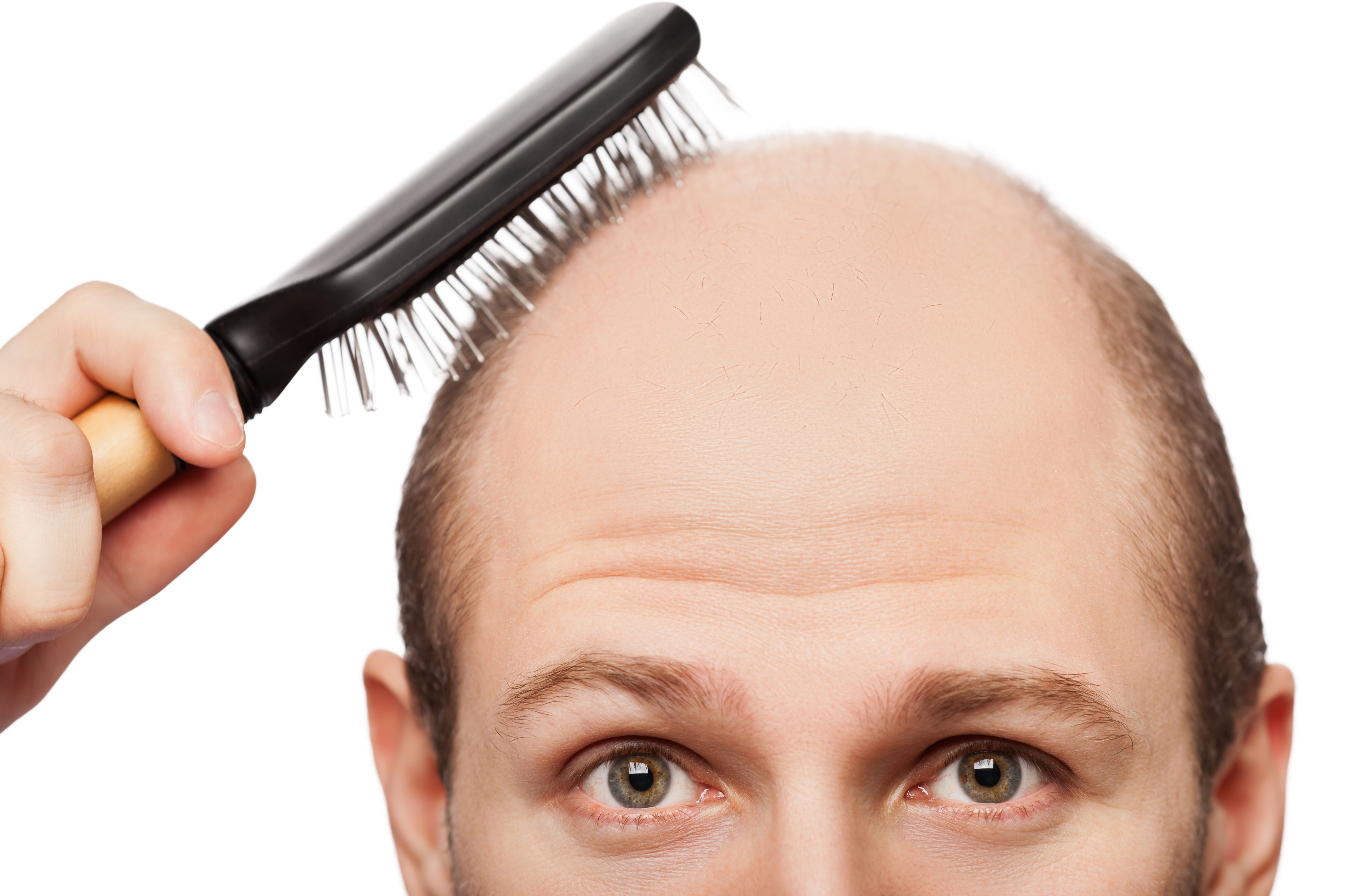 alopecia hair loss cure causes in men