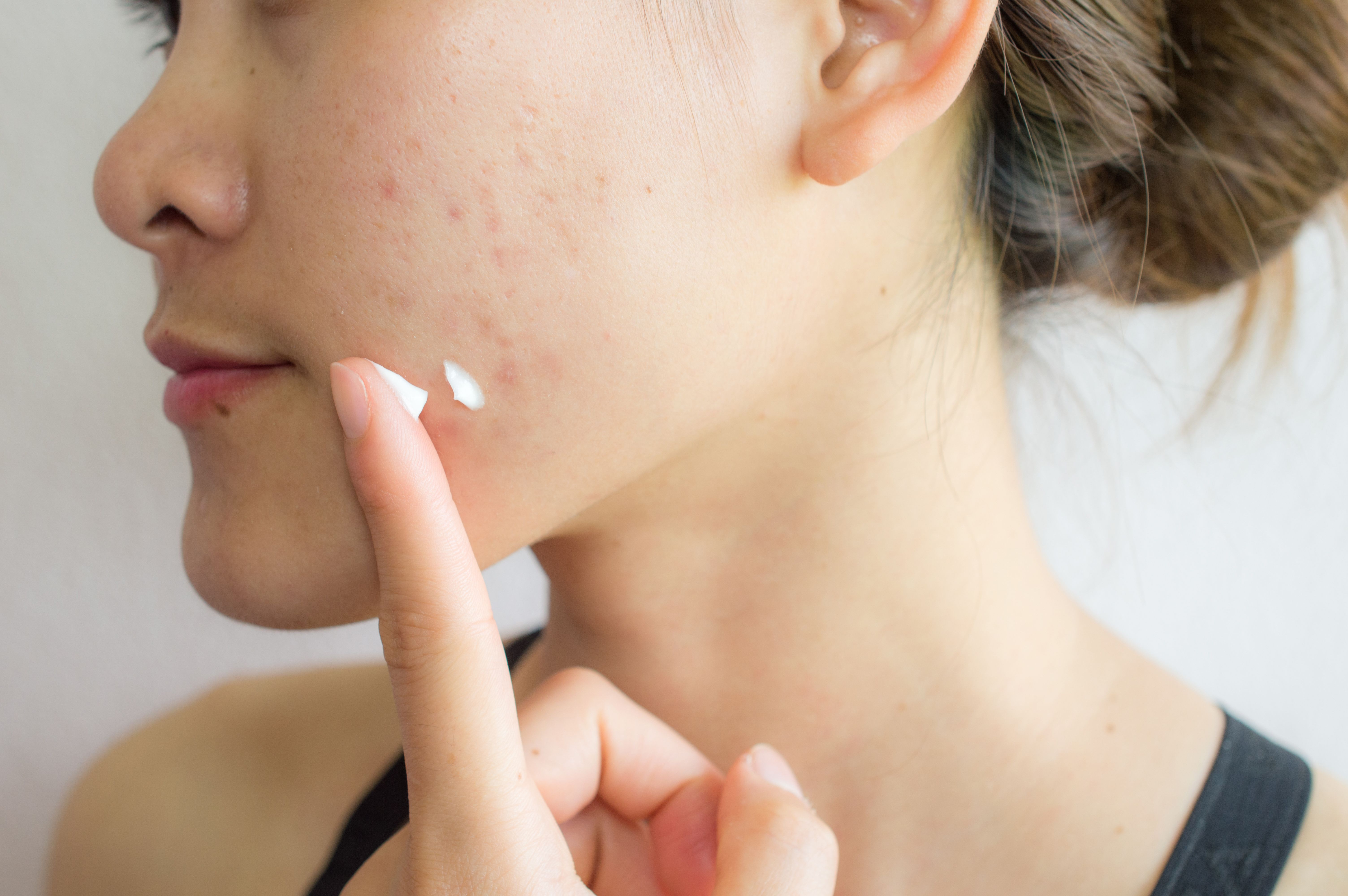 dermatologe akne behandlung
