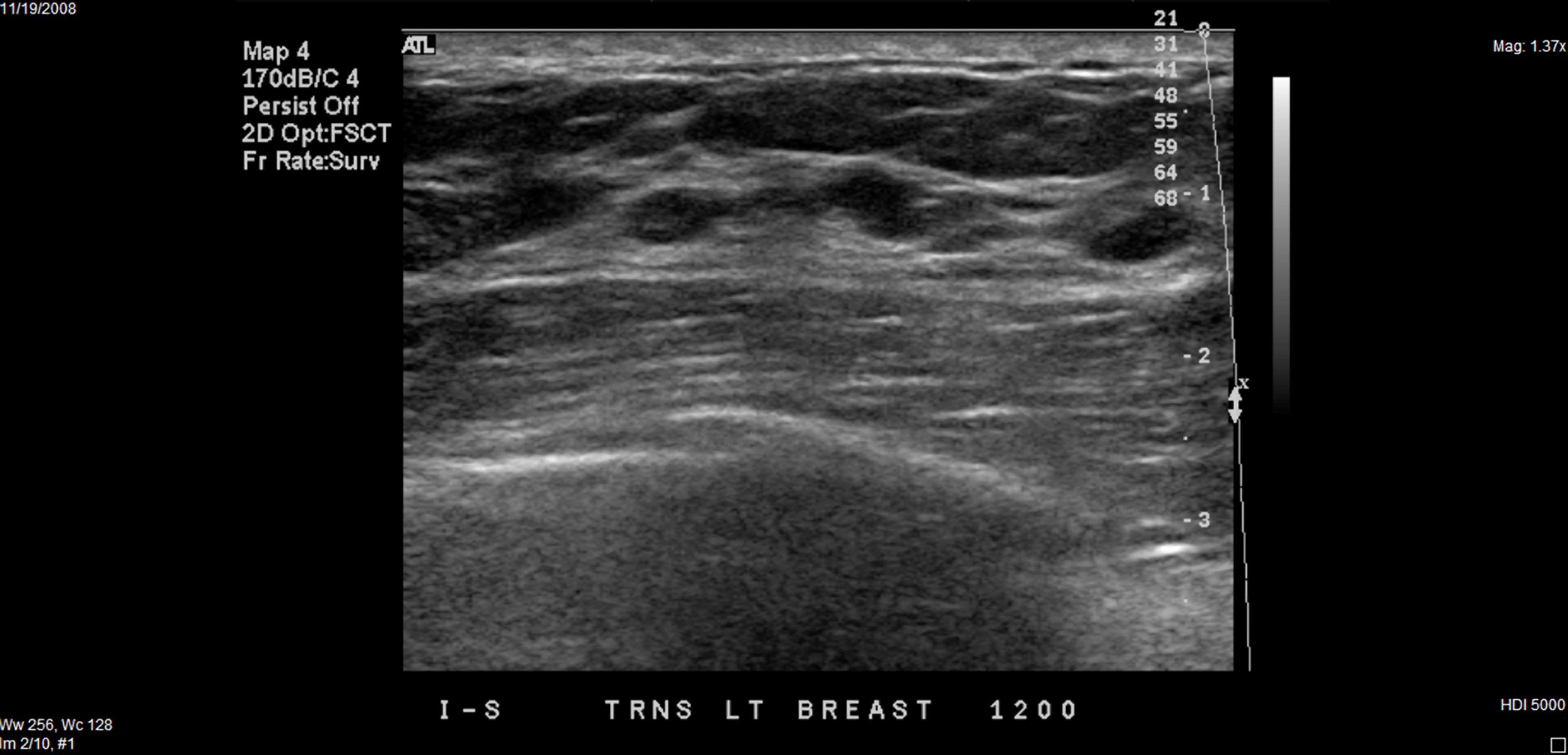 ultrasound breast