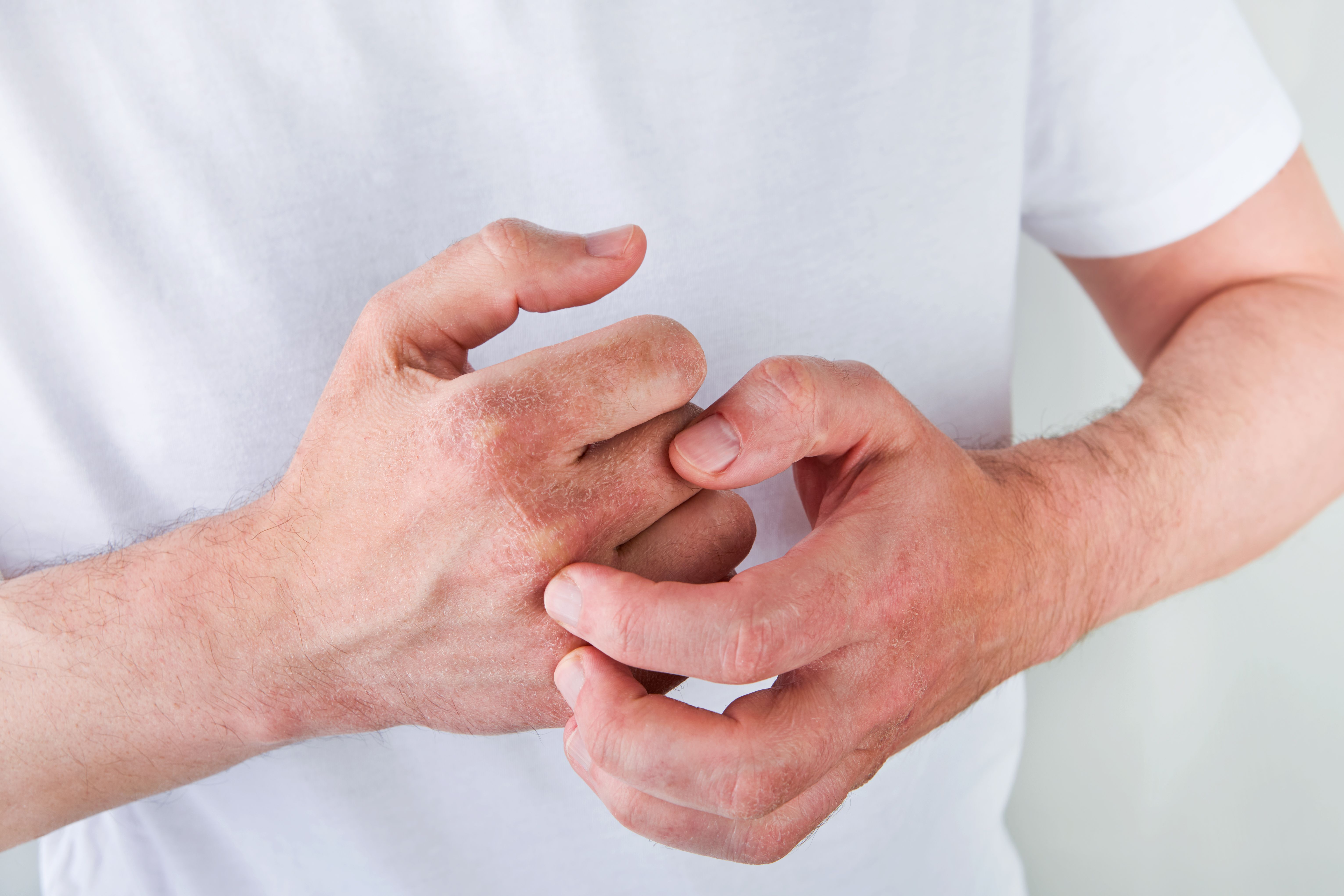 Man scratches or shows hands with dry, cracked skin on white backgrounds. Problem with many people - eczema on hand, allergies or dry skin. Health care concept. Close up.