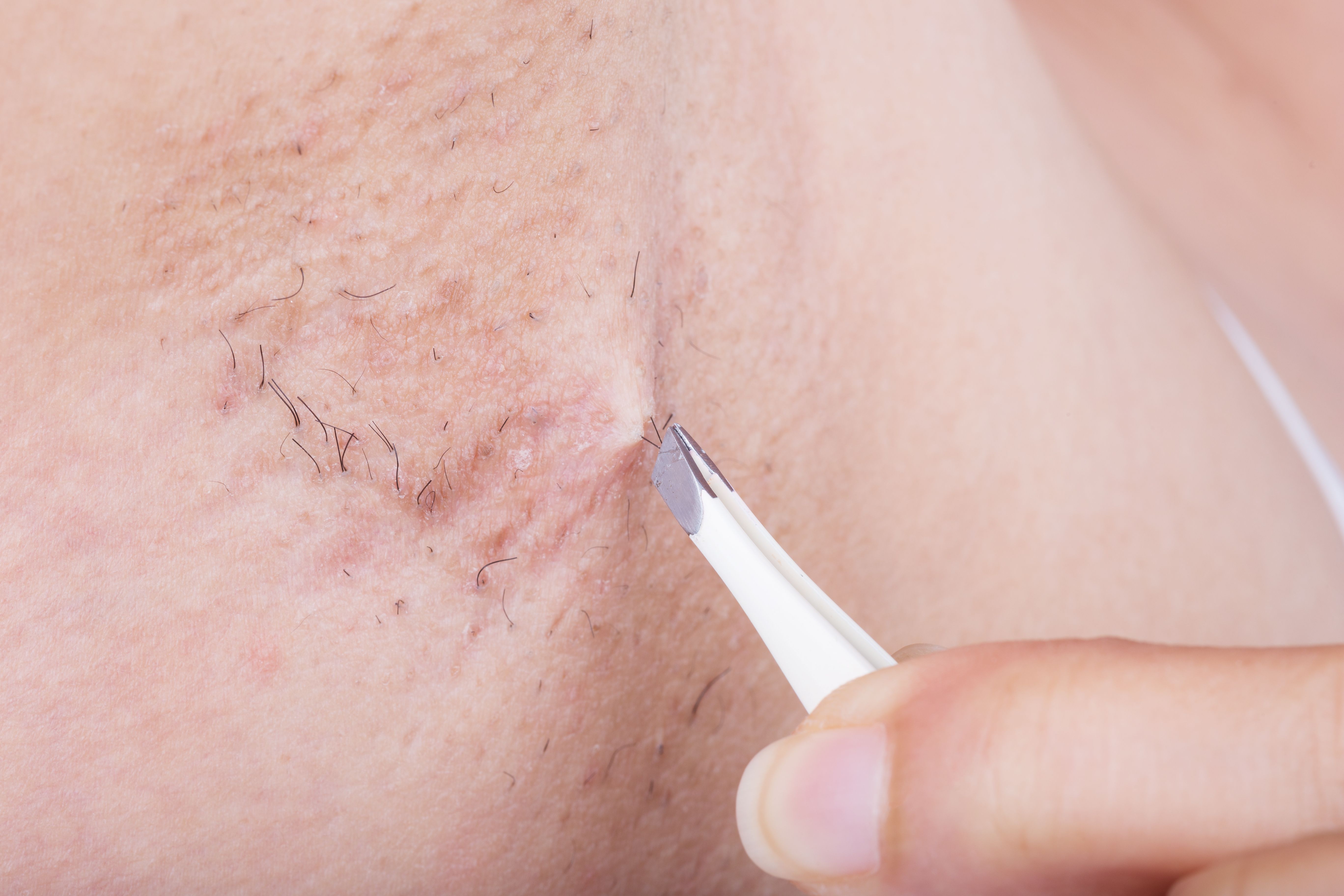 prevent ingrown hairs