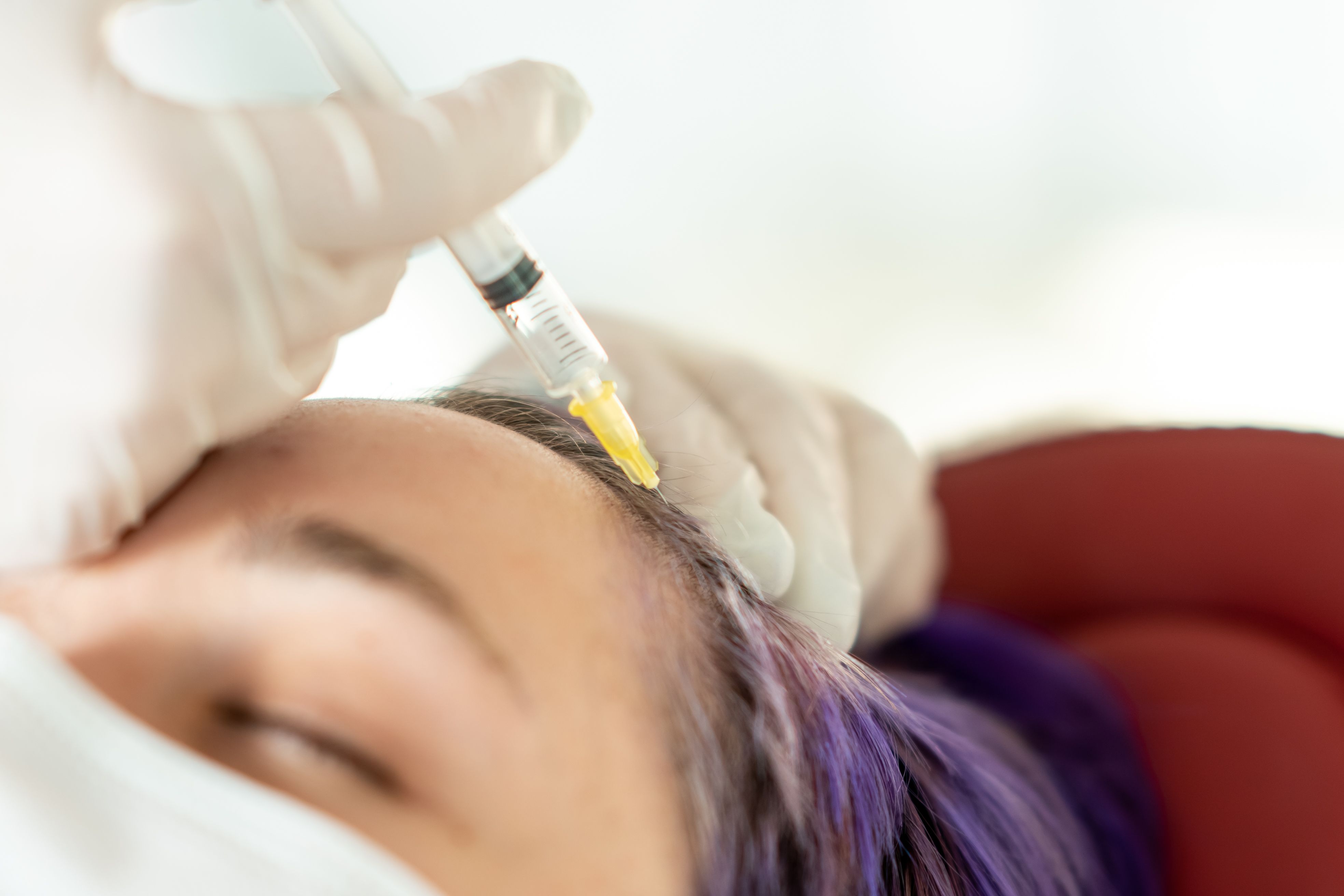 Prp for hair loss minoxidil leicester