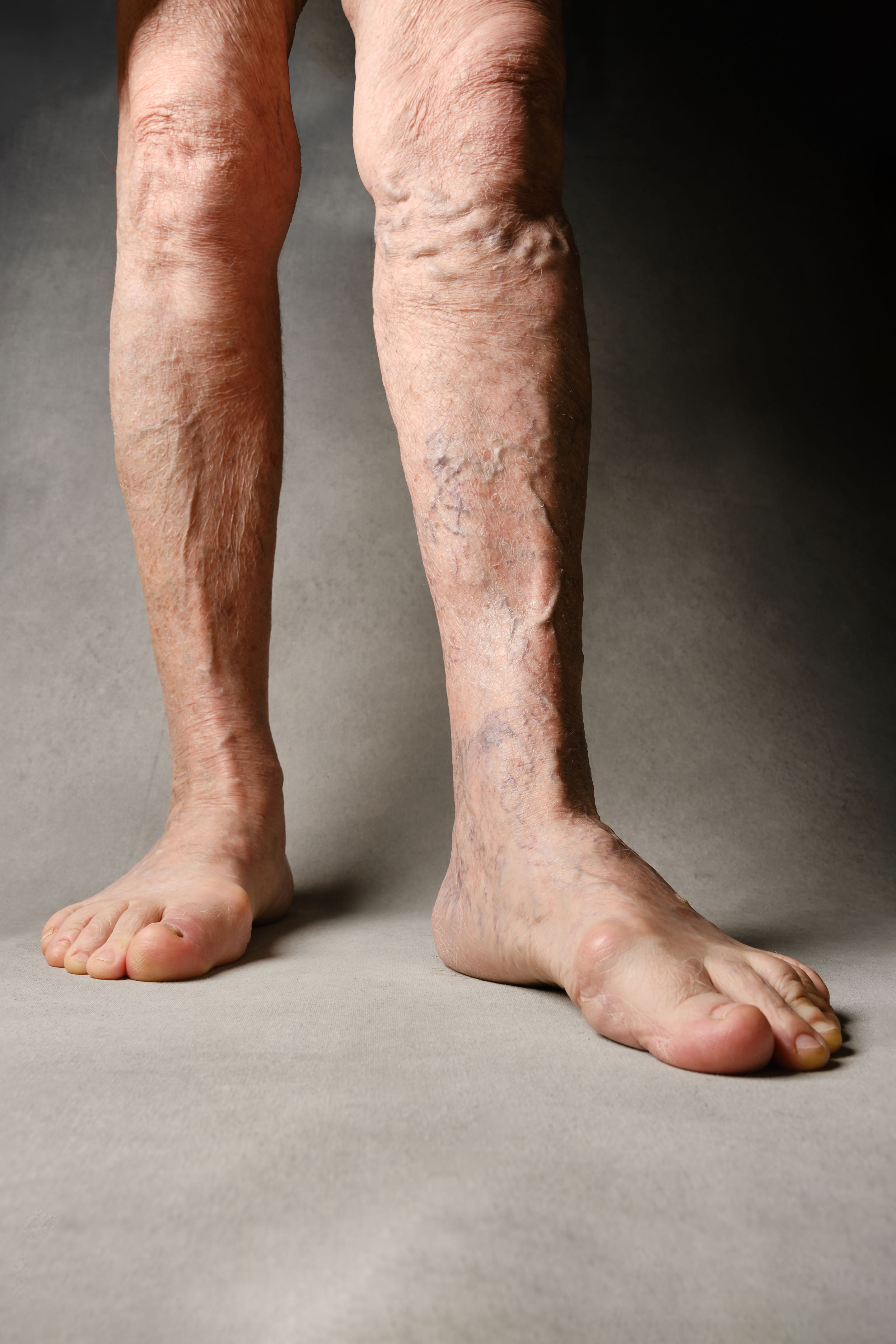 varicose veins