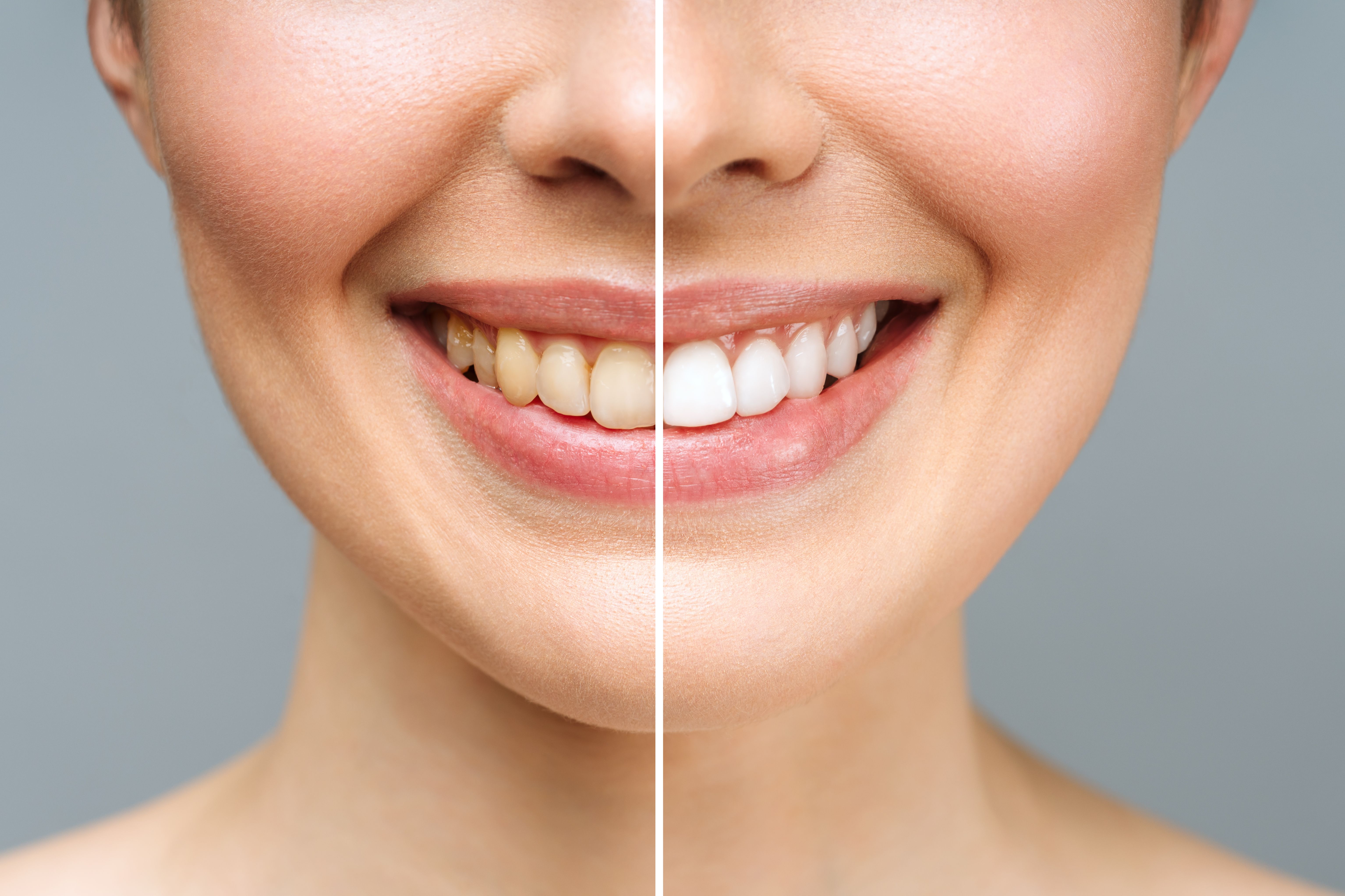 whitening teeth