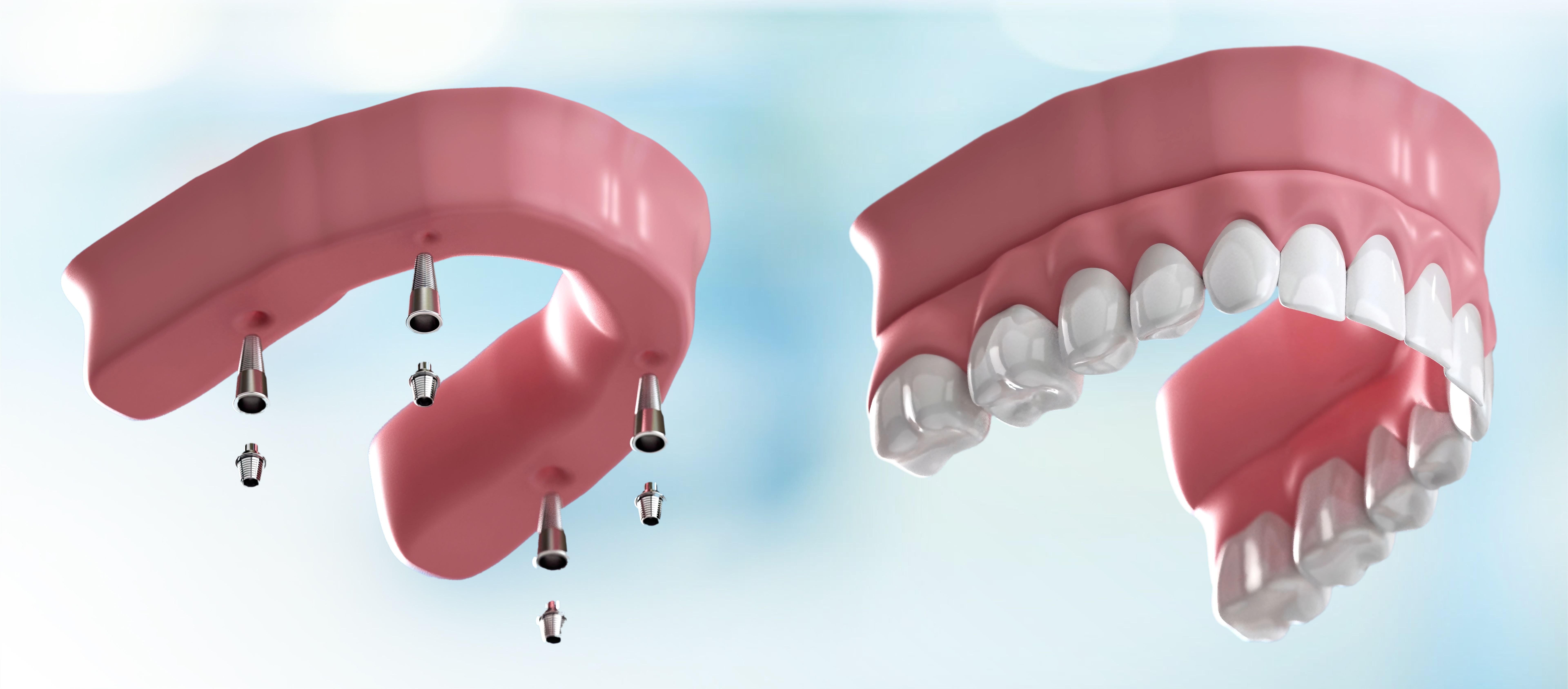 dental implant
