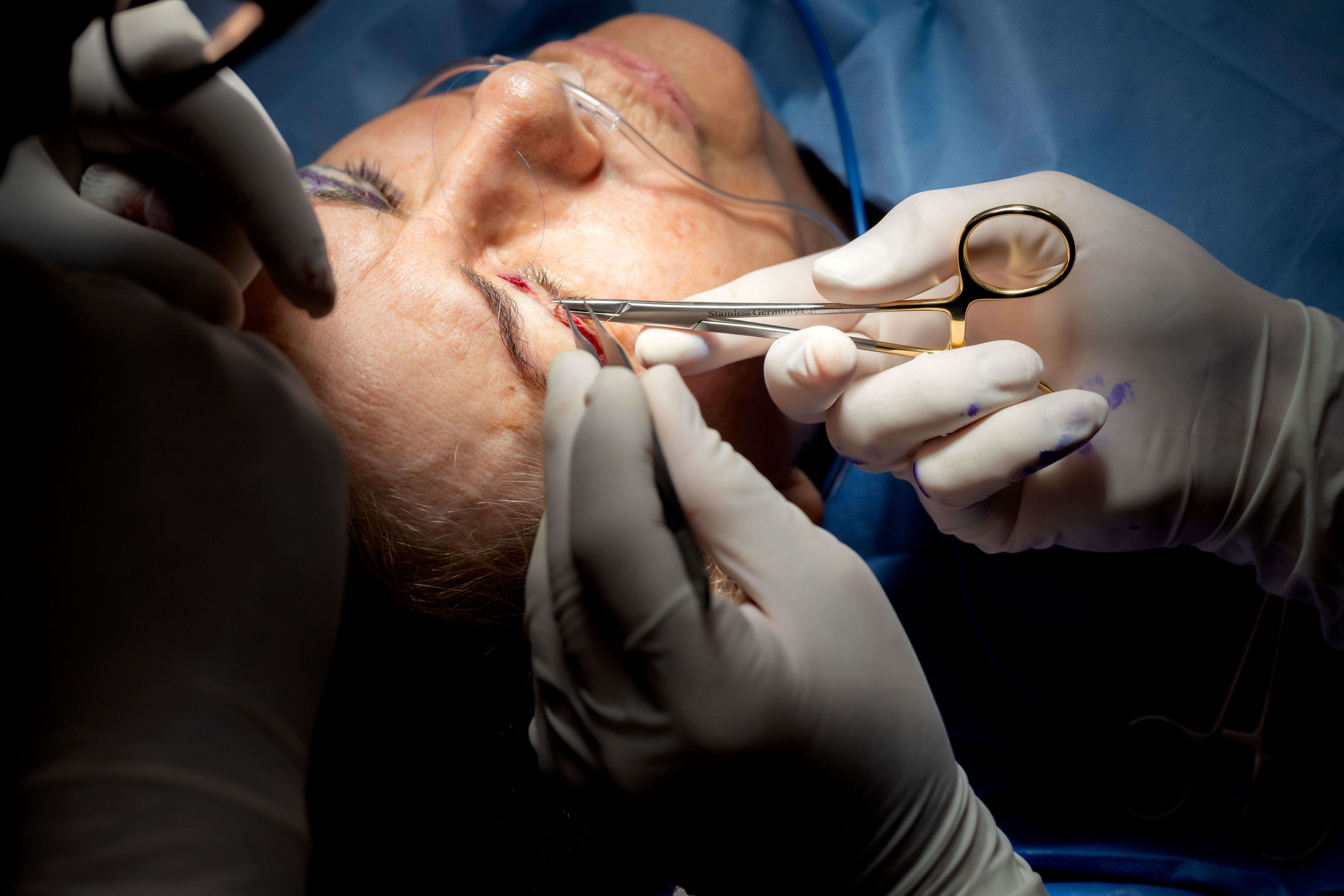 blefaroplastia procedimiento