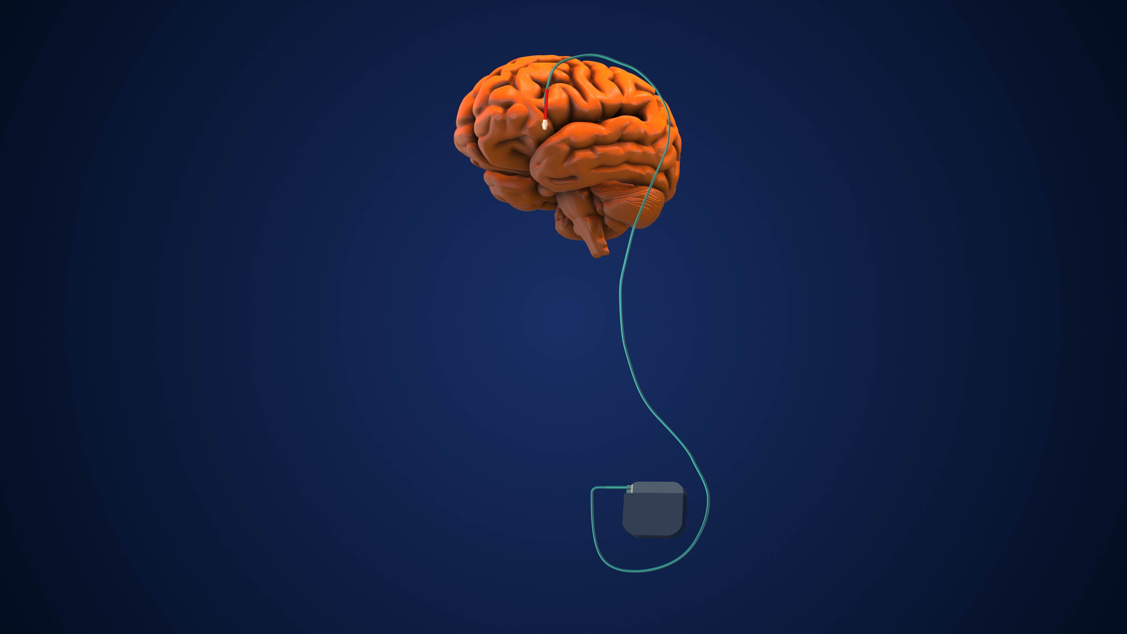 brain stimulation therapy