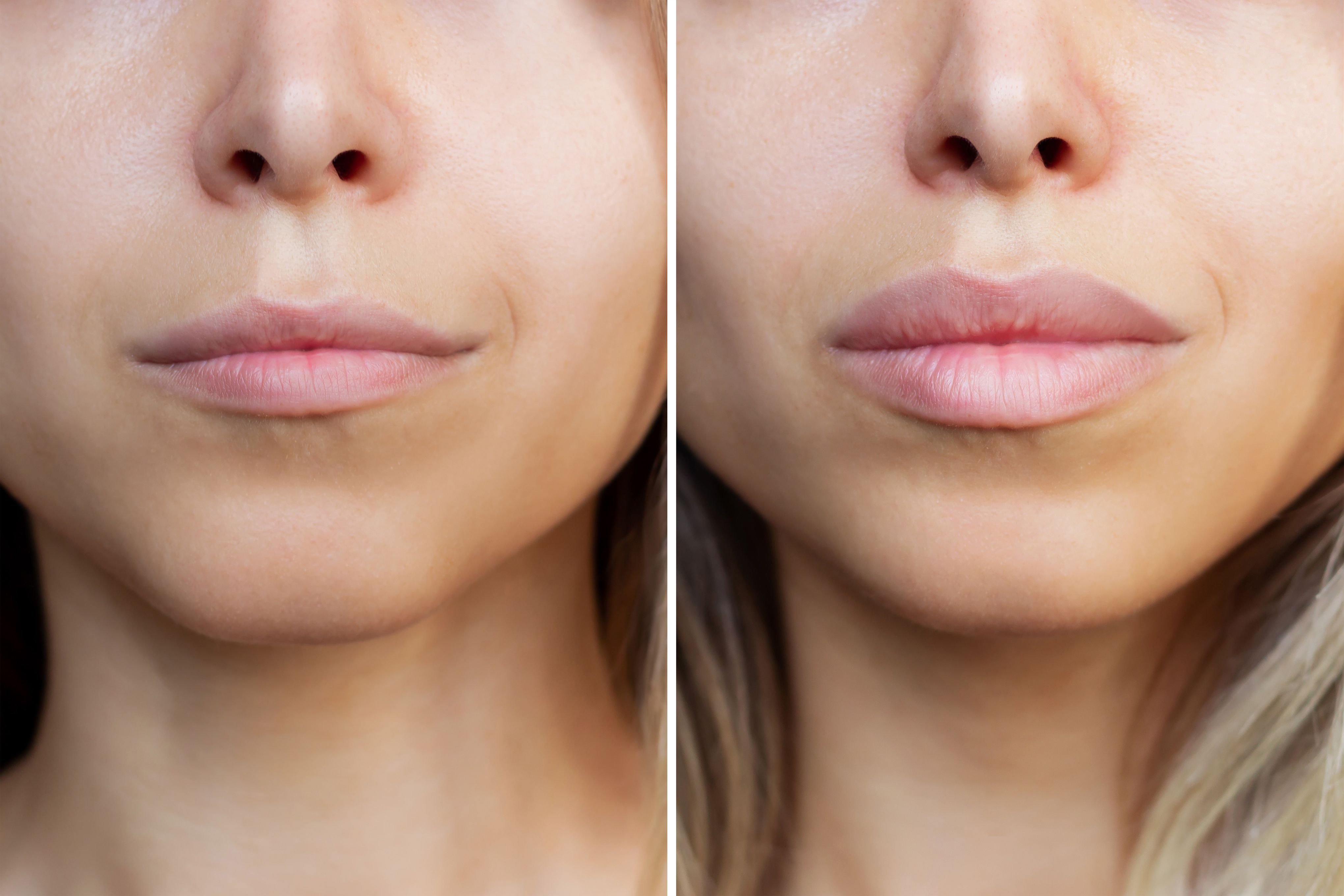 before and after lips