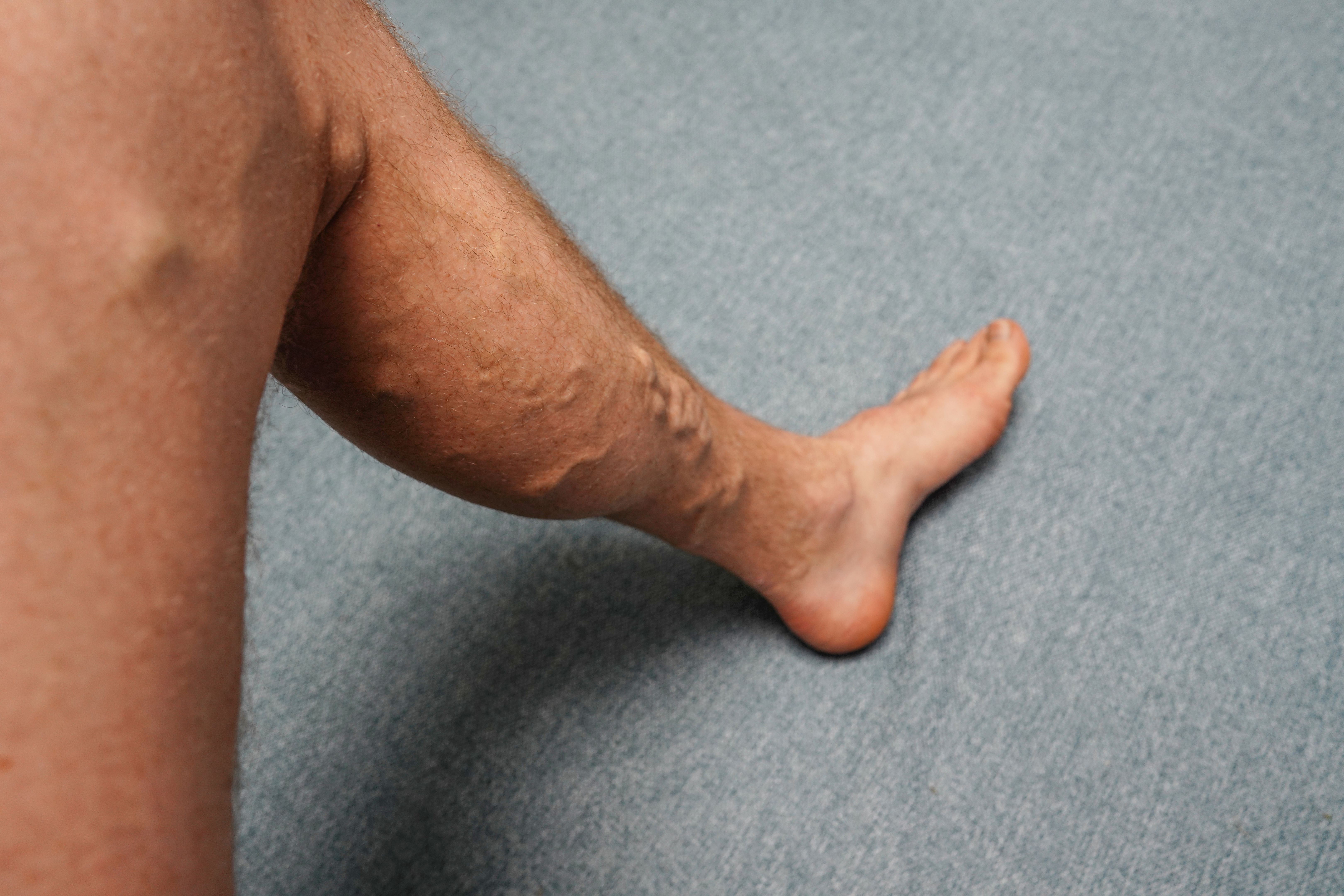 varicose veins treatment