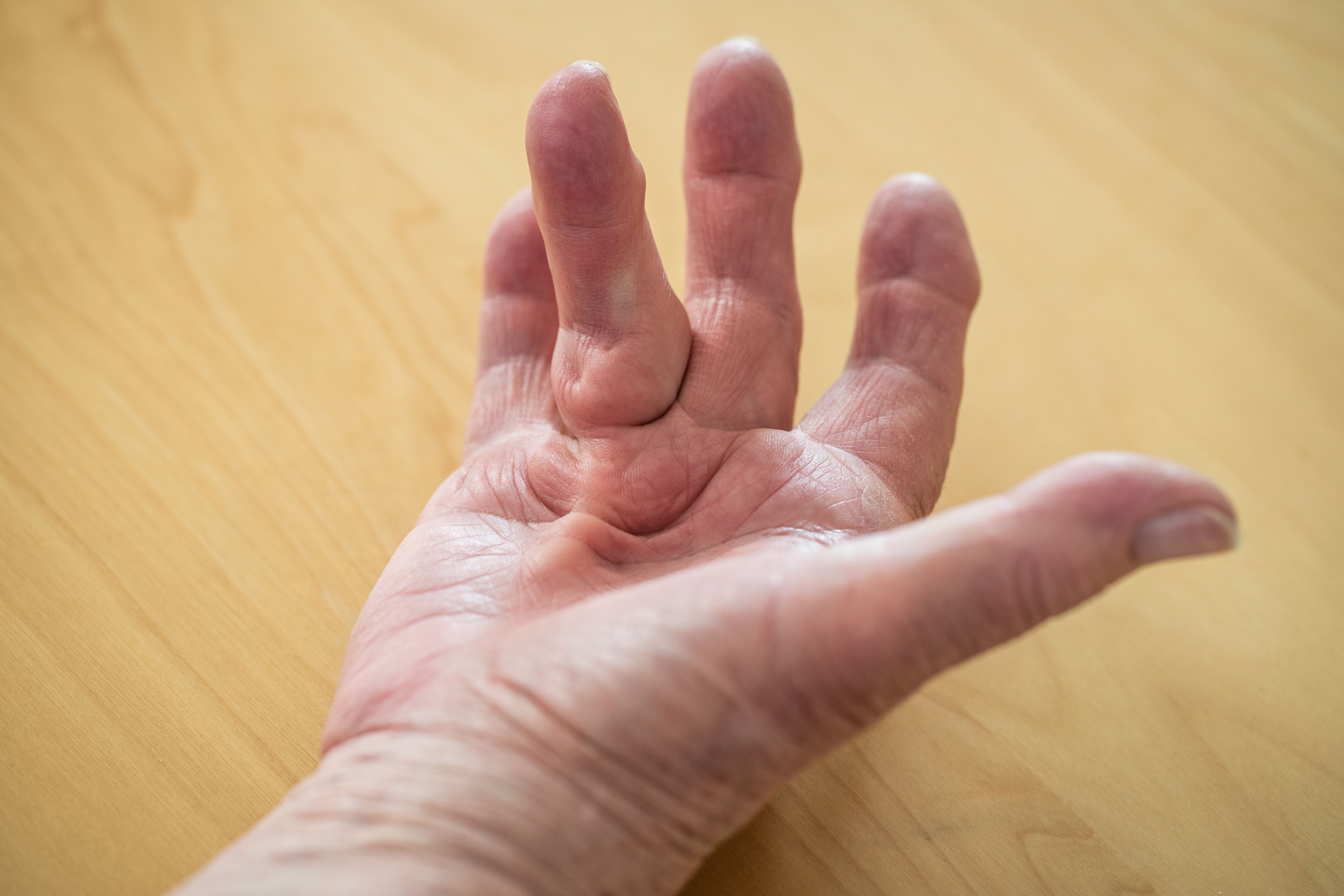 Dupuytren's contracture of ring finger on woman's palm Dupuytren's contracture of ring finger on woman's palm