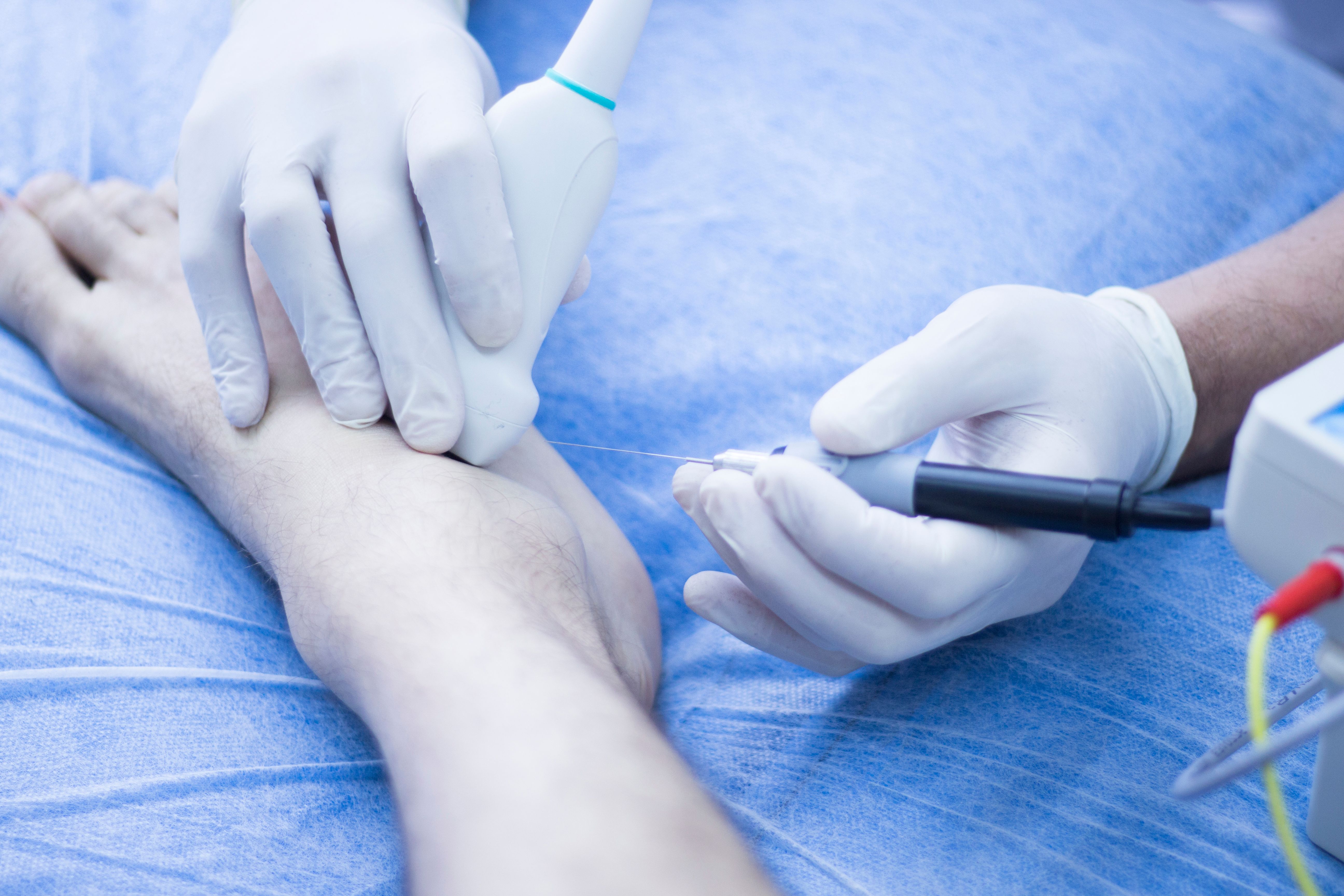ultrasound guided sclerotherapy