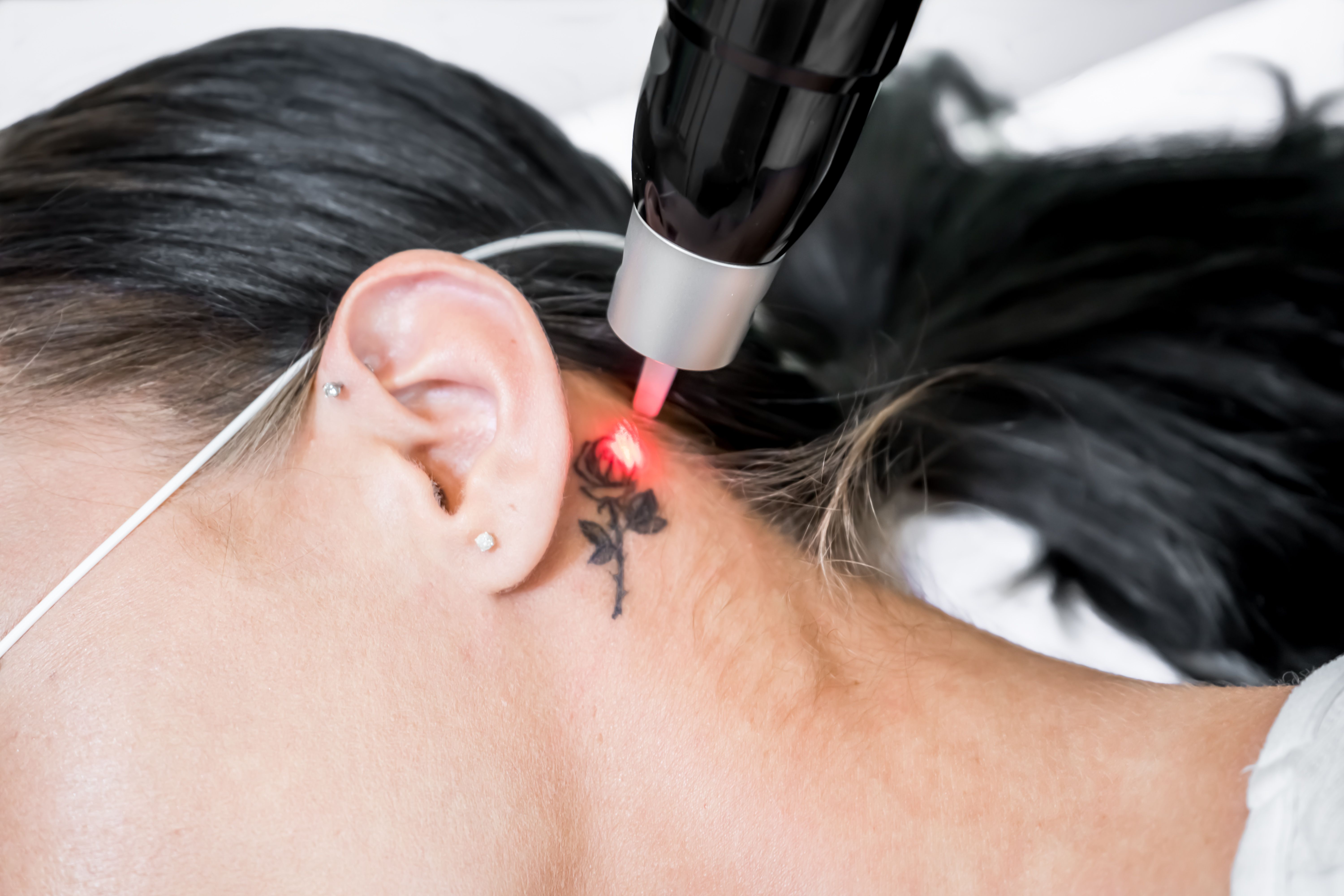 laser treatment