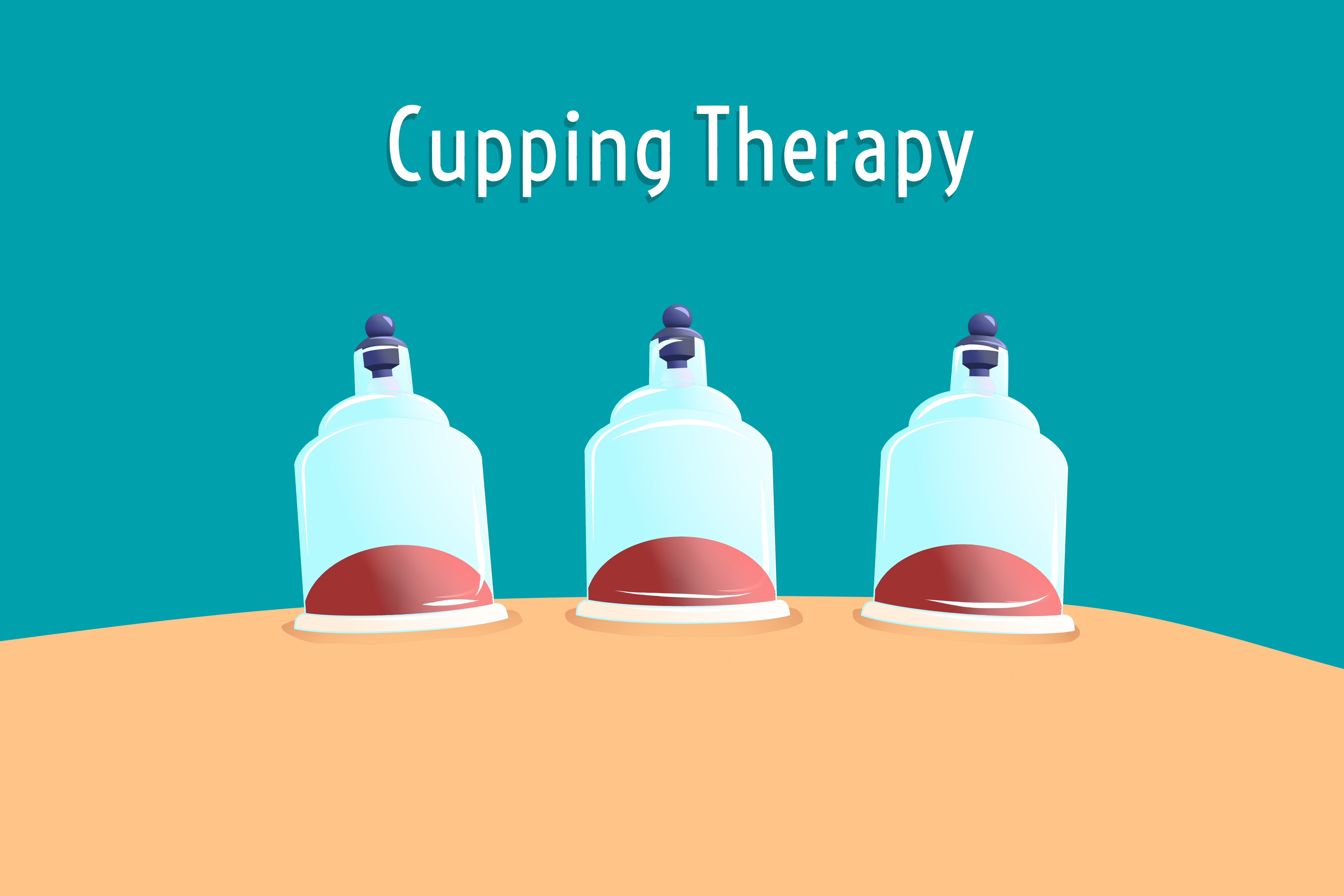 Illustration of traditional Chinese medicine therapy. cupping therapy, a treatment used to relieve pain and other health benefits. Selective focus.