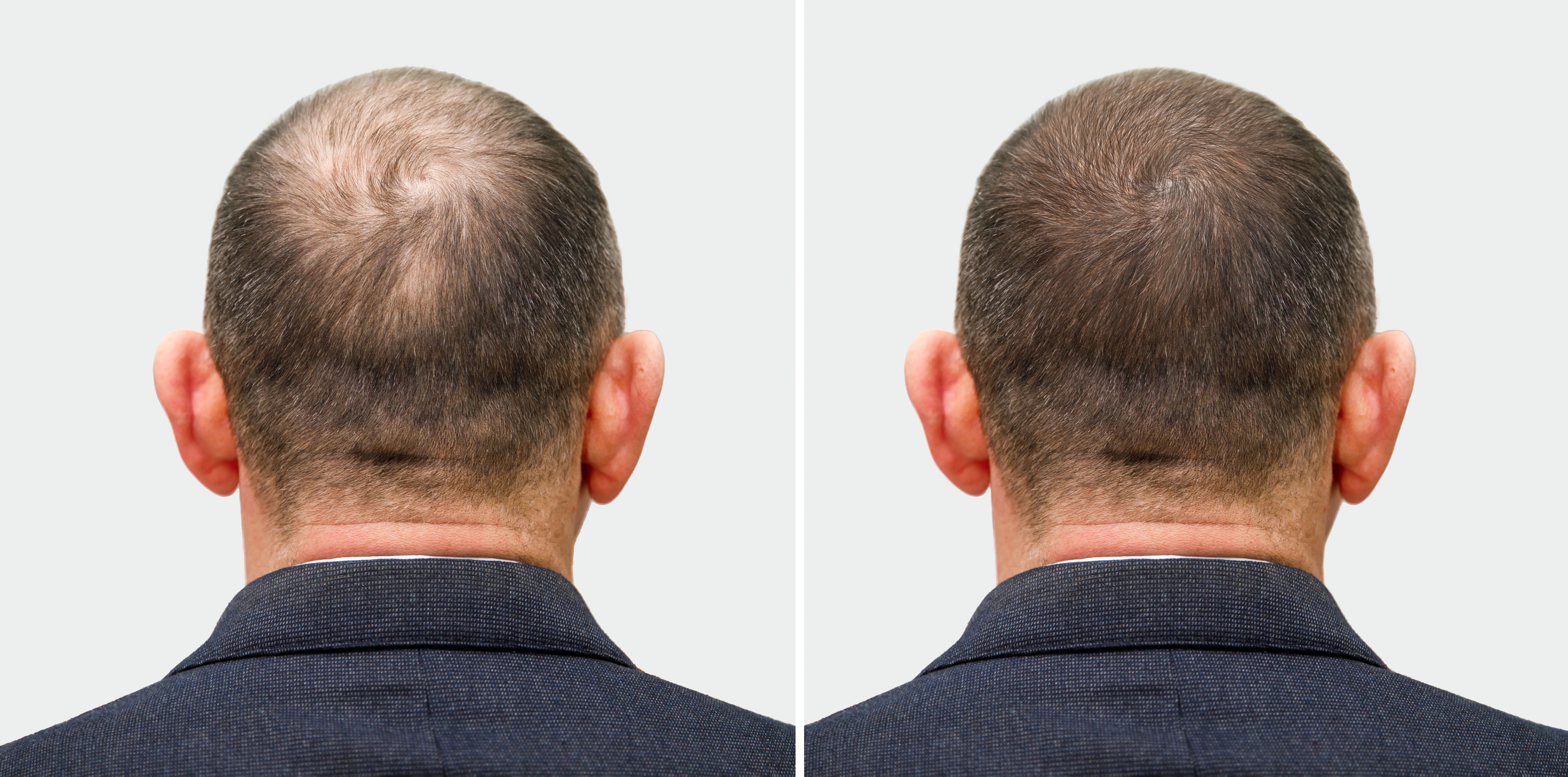 before and after hair transplant