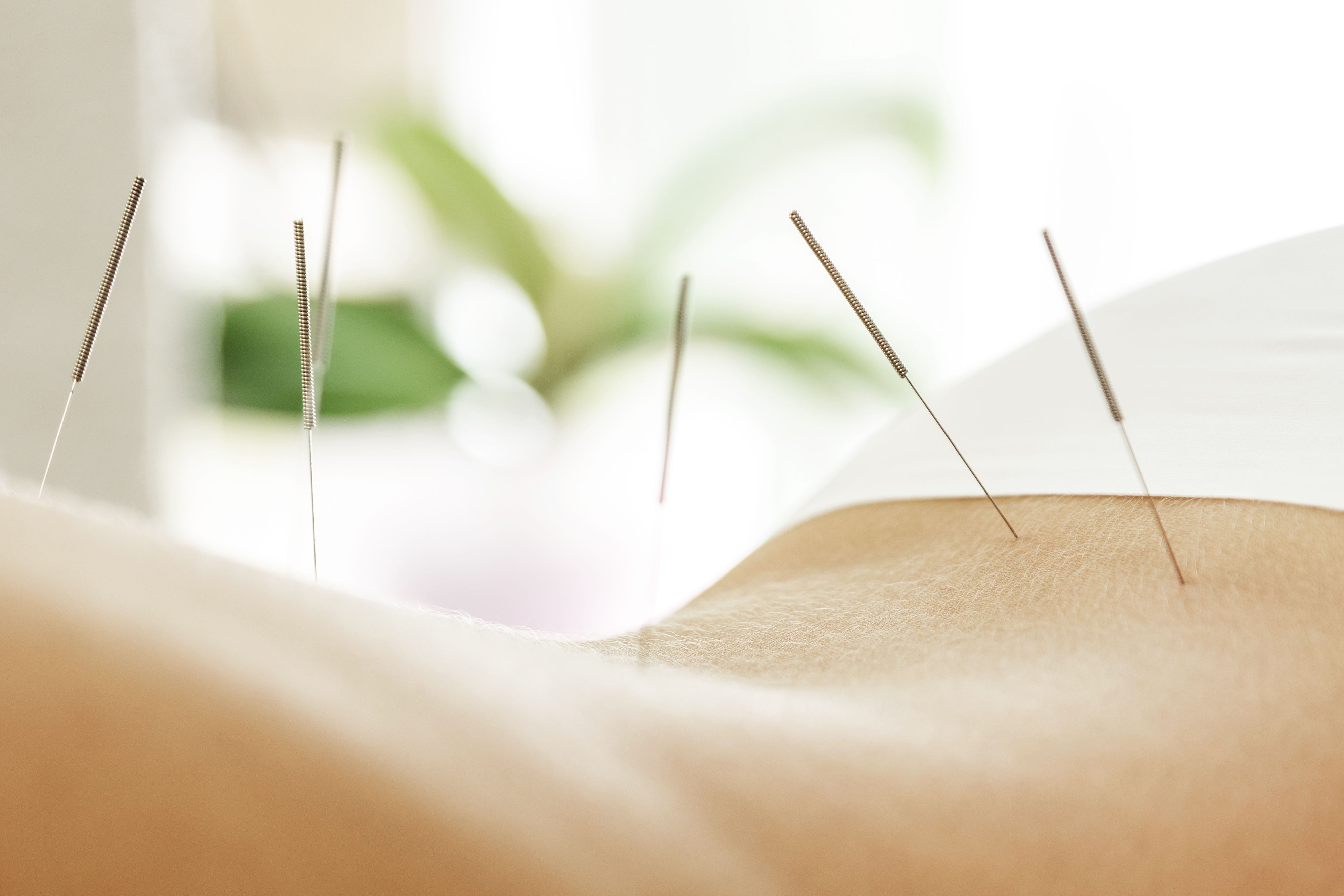 acupuncture recovery