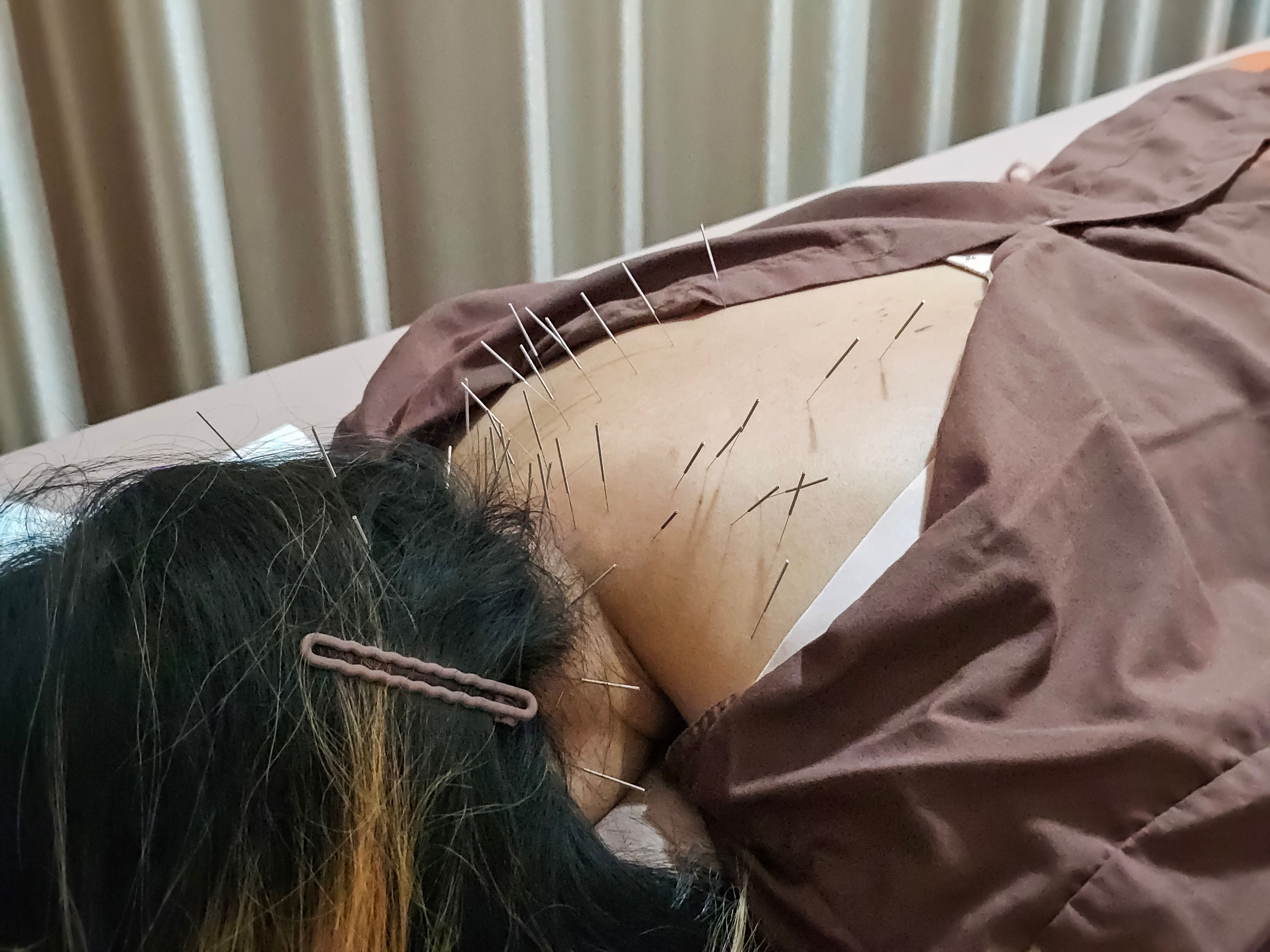 relaxing acupuncture