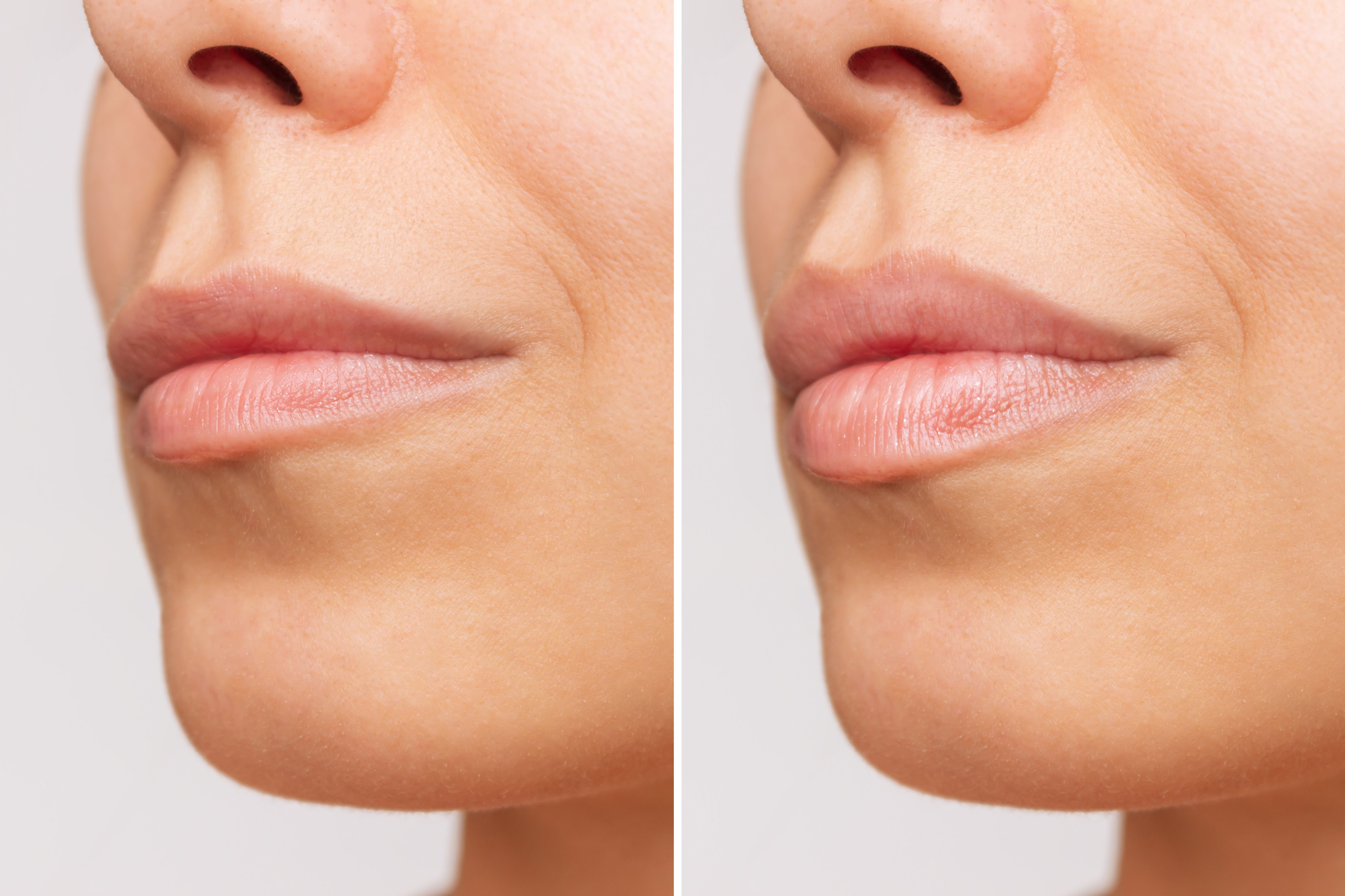 before after lips