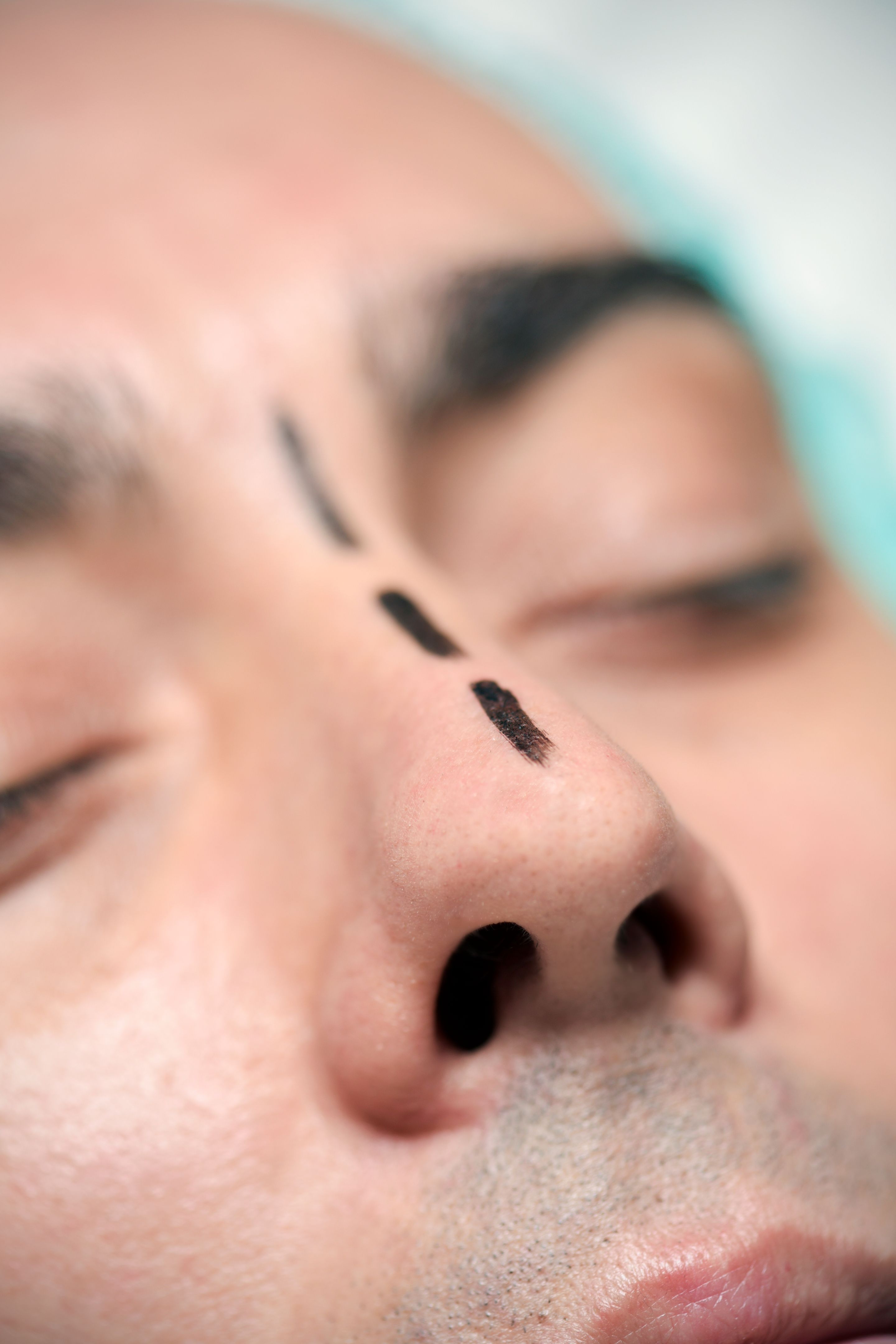 men rhinoplasty