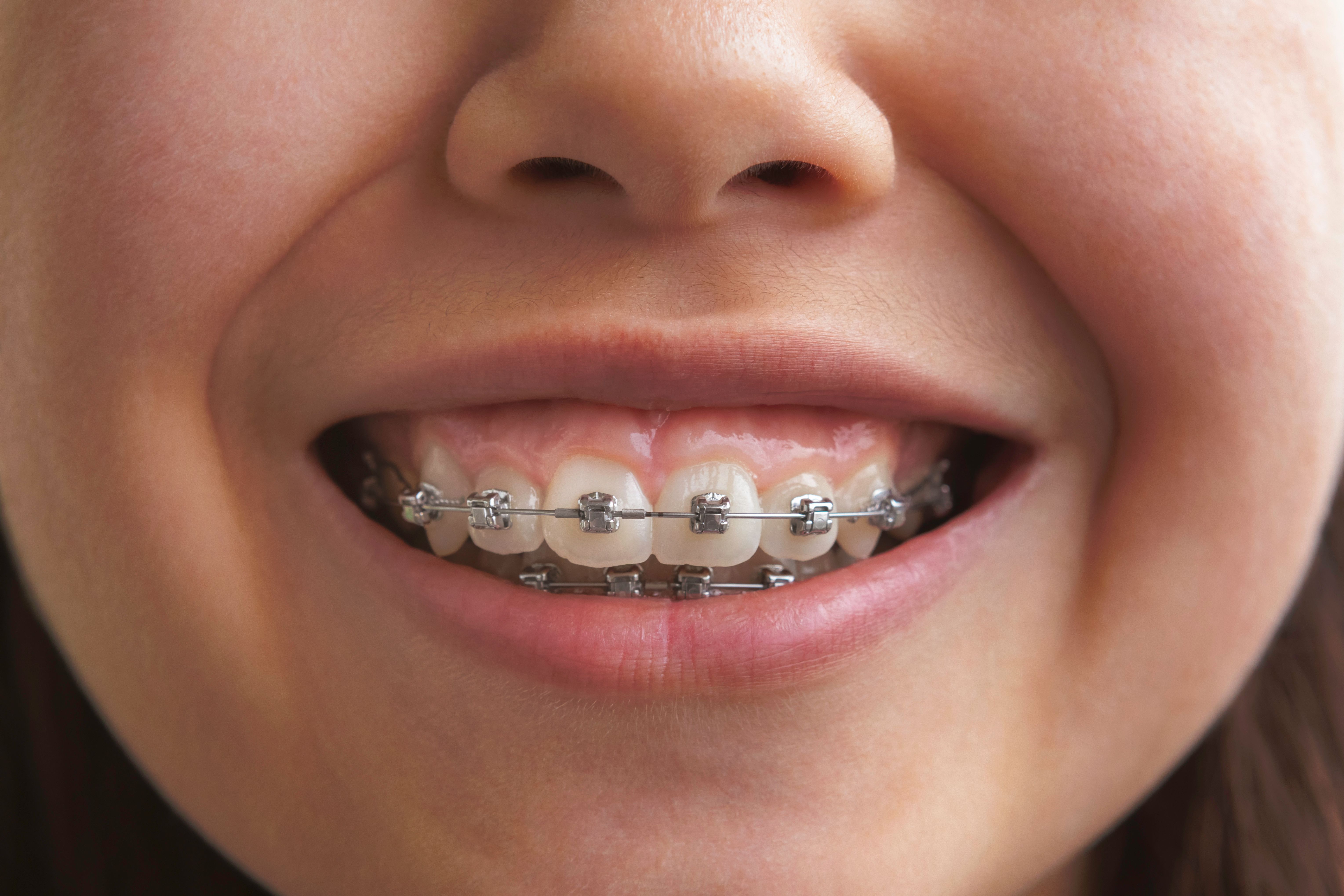 child orthodontics