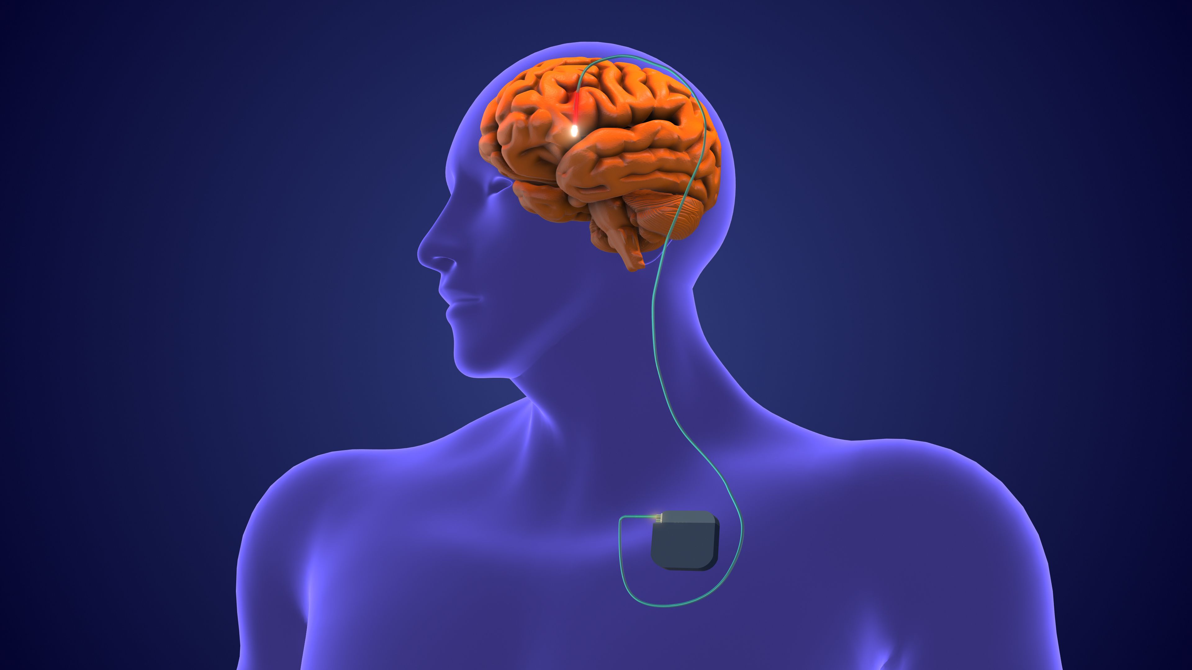deep brain stimulation