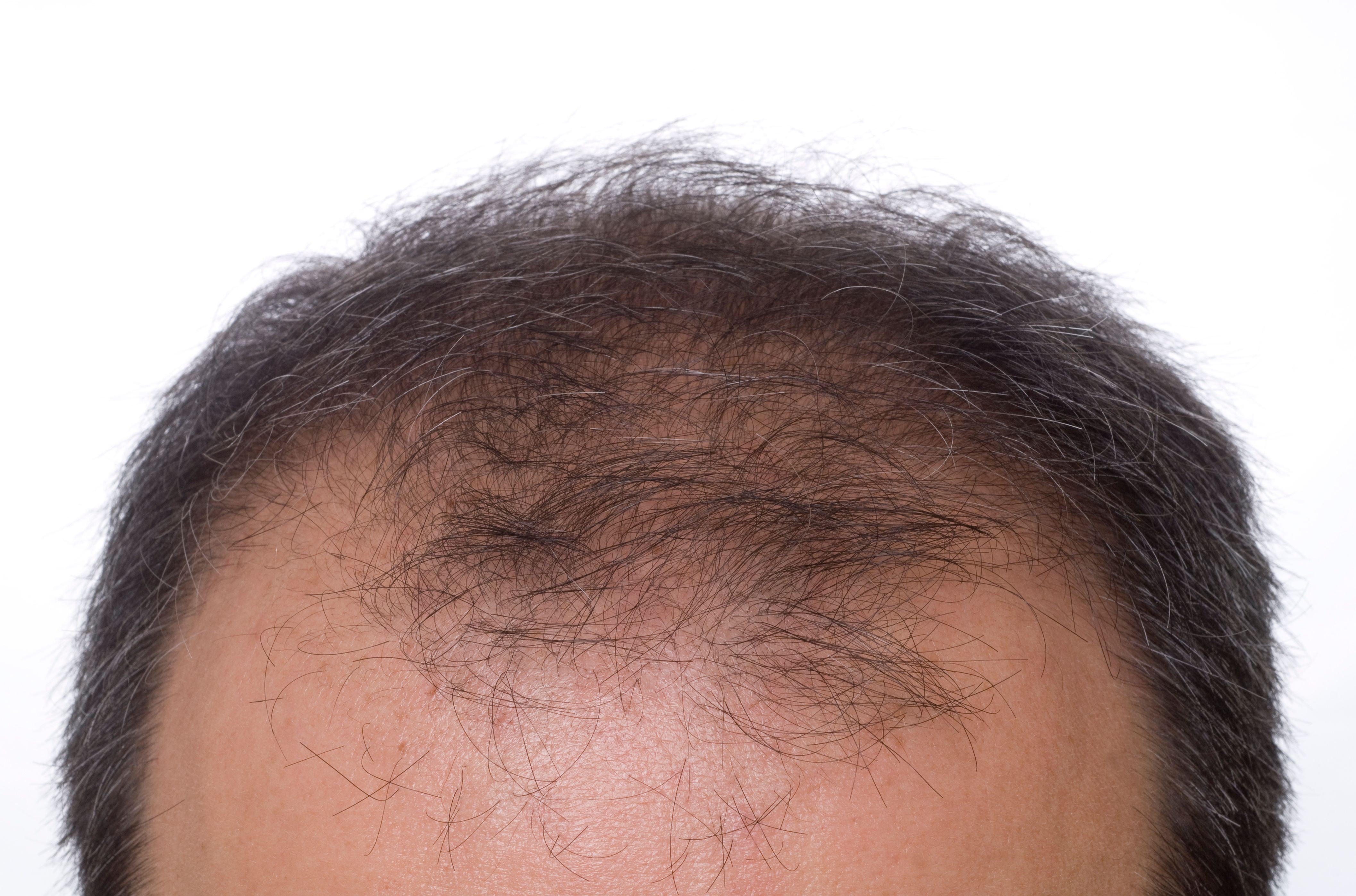 Hair loss treatment leicester minoxidil prp