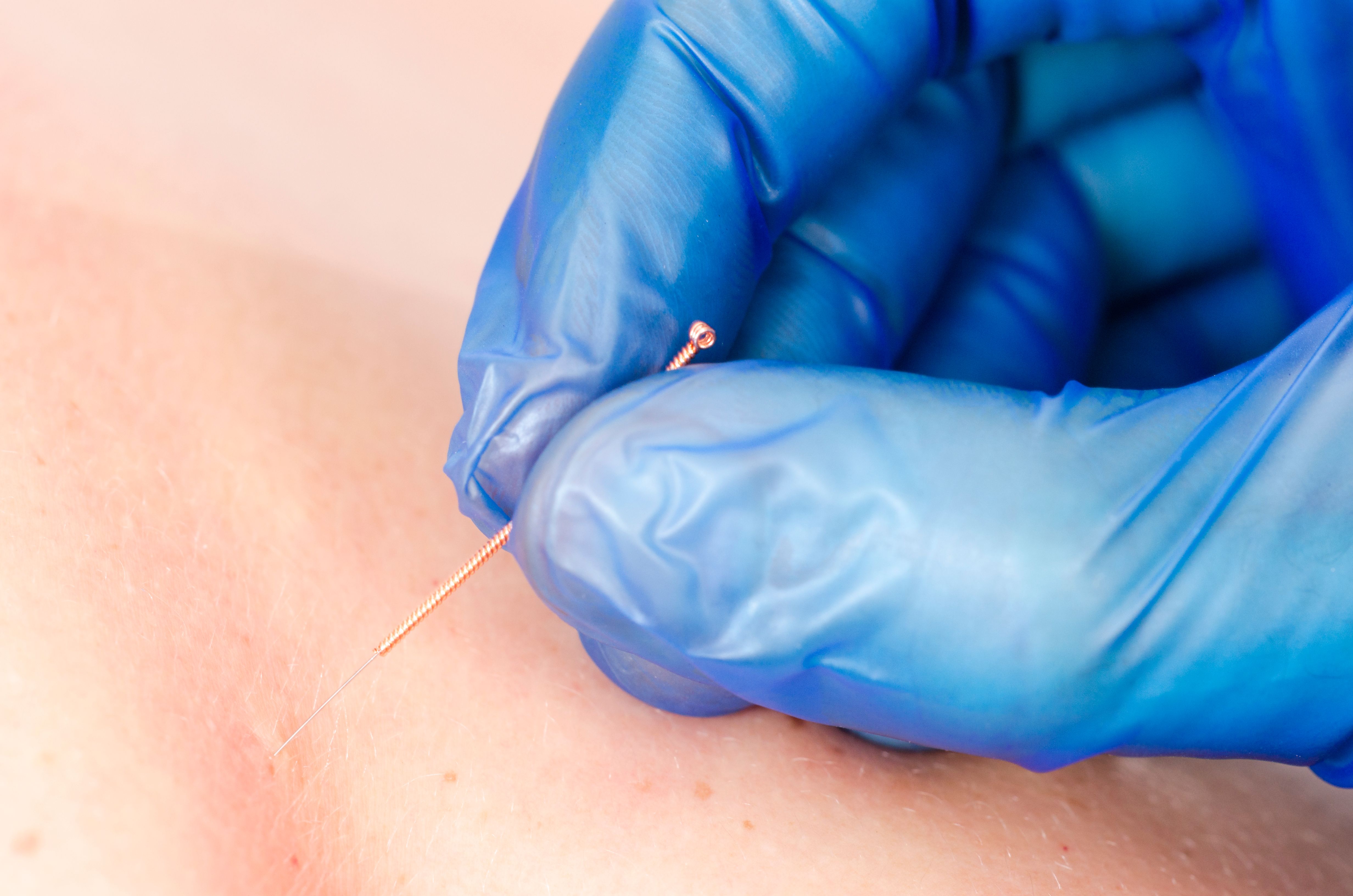 Needle and hands of physiotherapist doing a dry needling.
