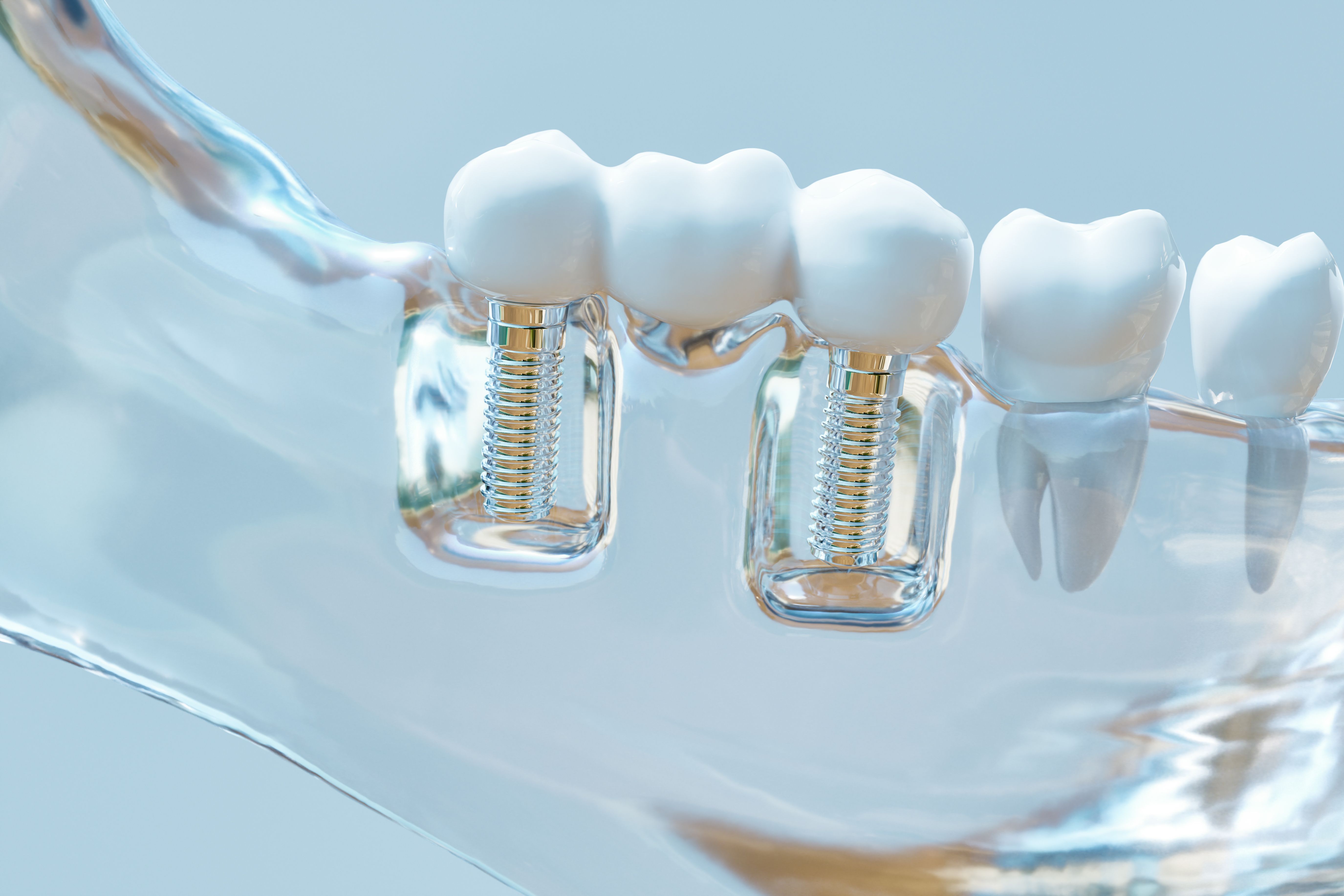 dental implants