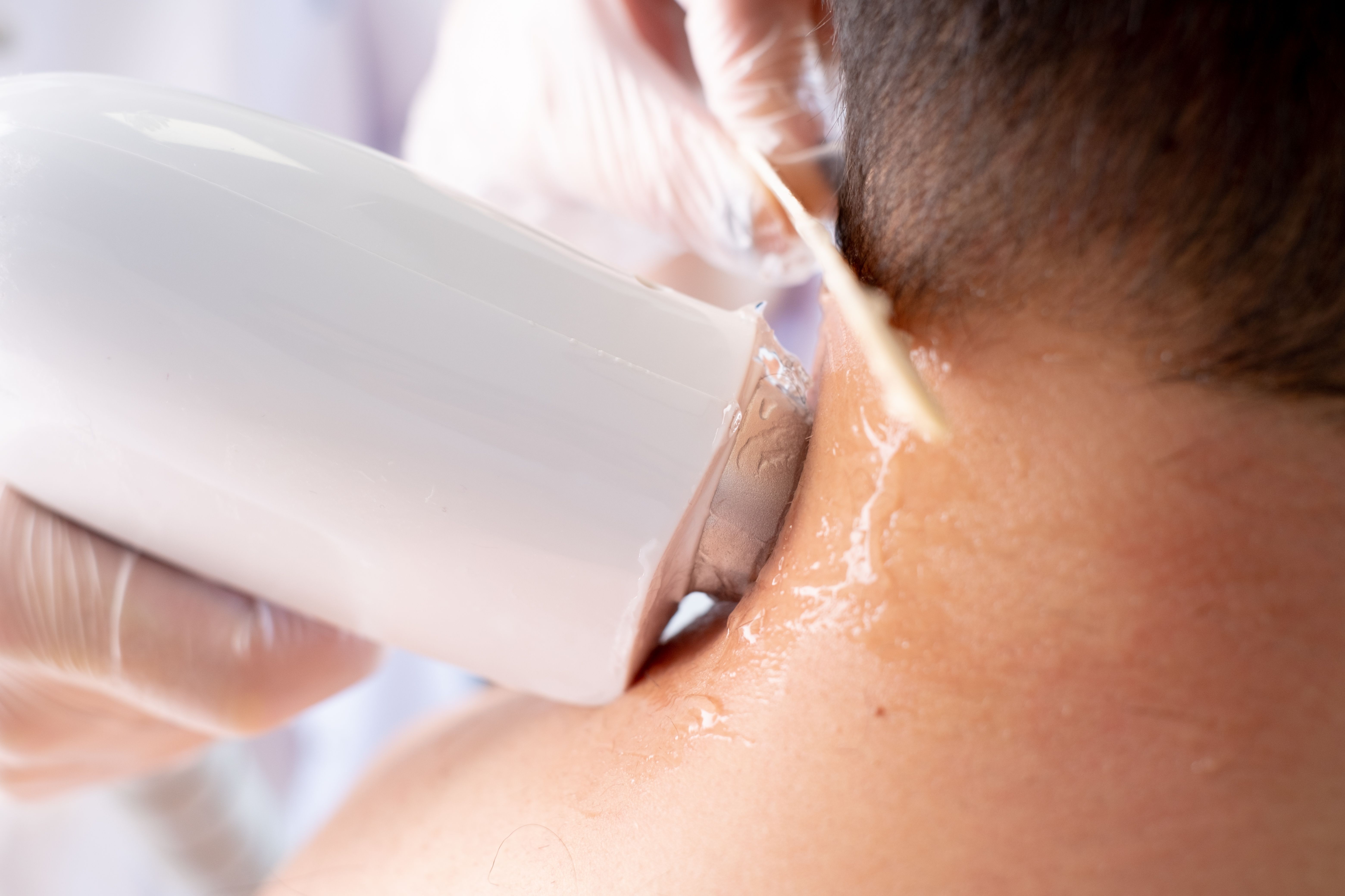 Cabelo laser removendo depilação no pescoço e ombro do homem