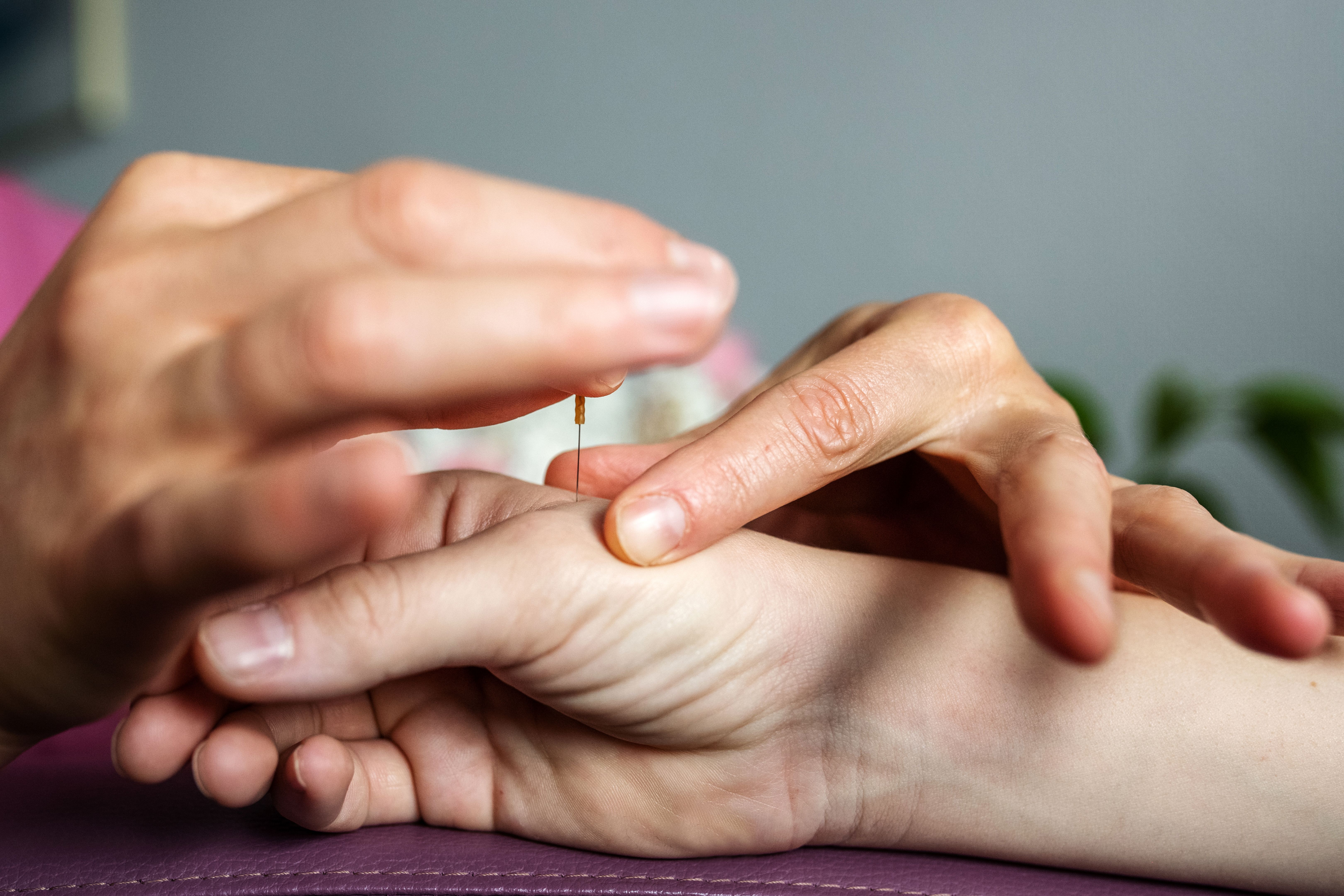 pain relief acupuncture
