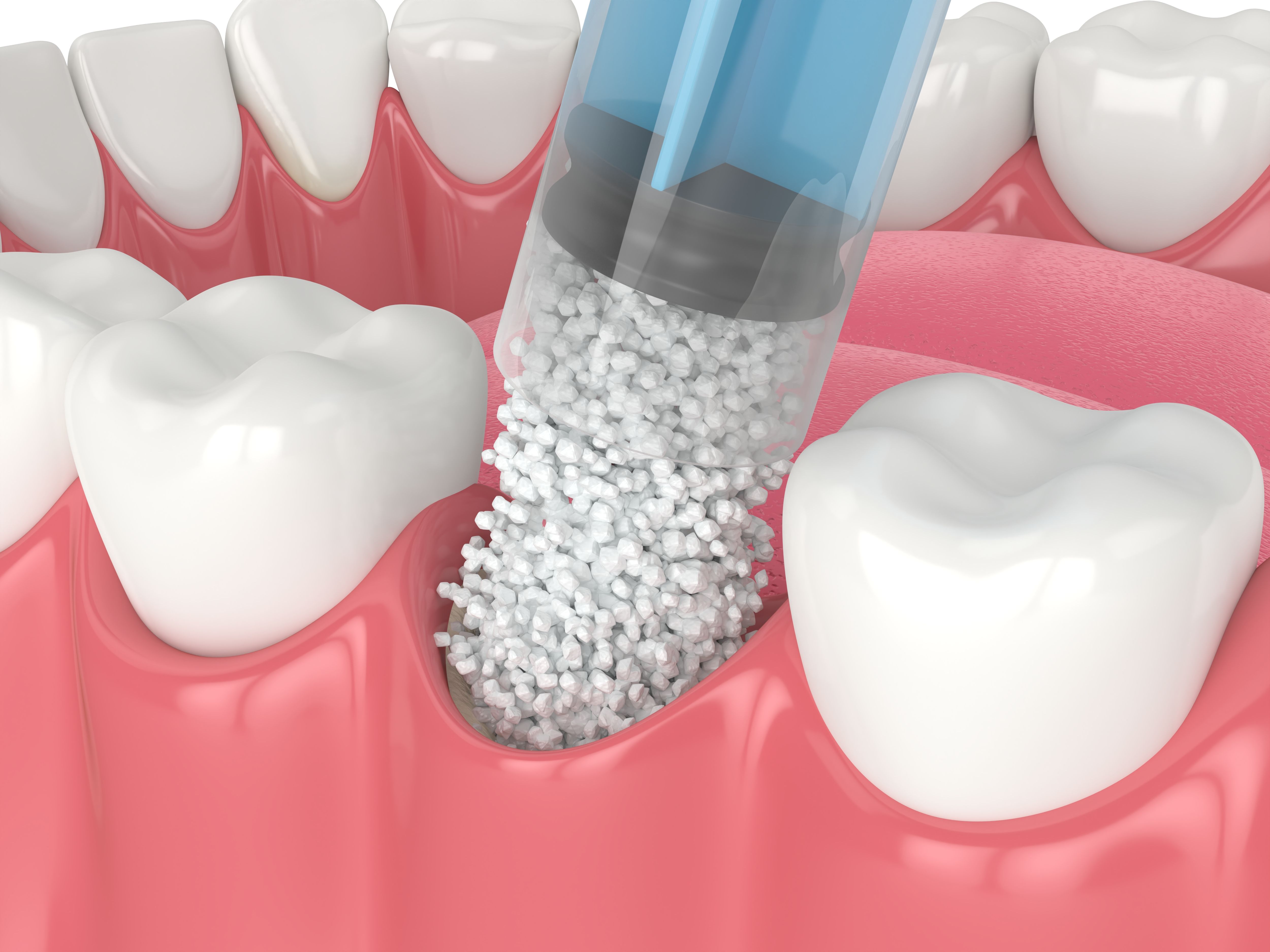 bone graft dentist