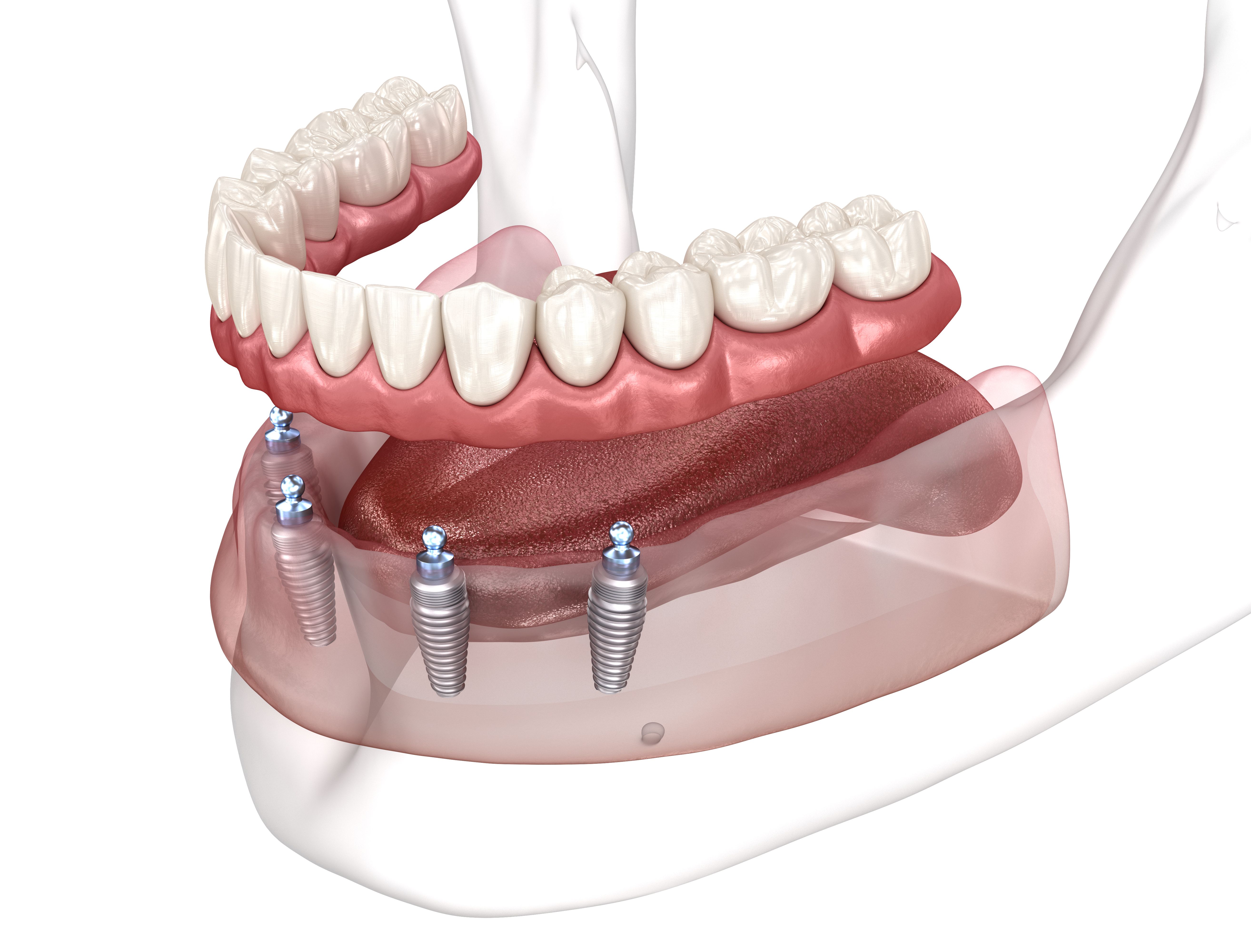 removable dental prosthesis