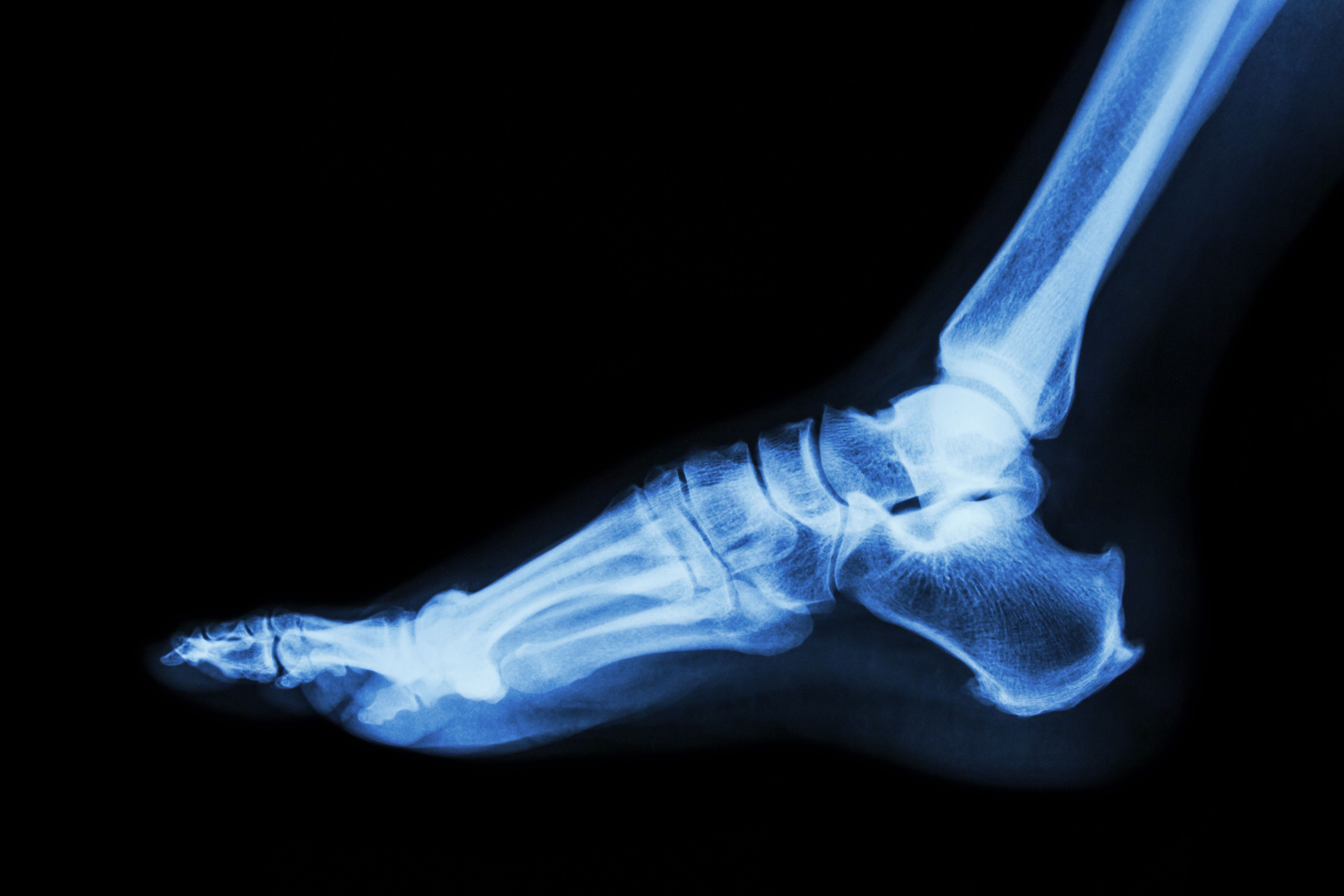 ankle x-ray