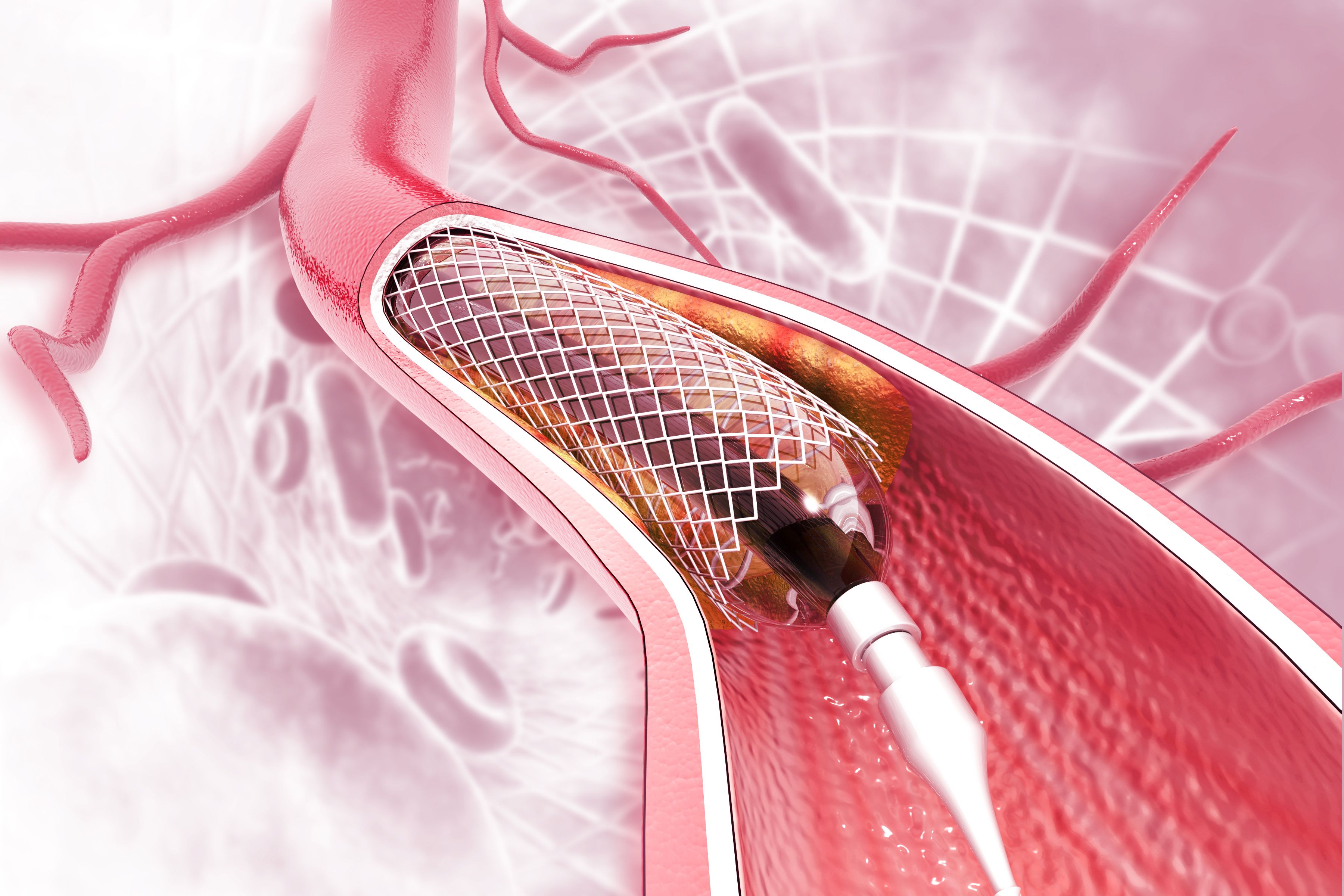 Angioplastia de stent sobre antecedentes científicos