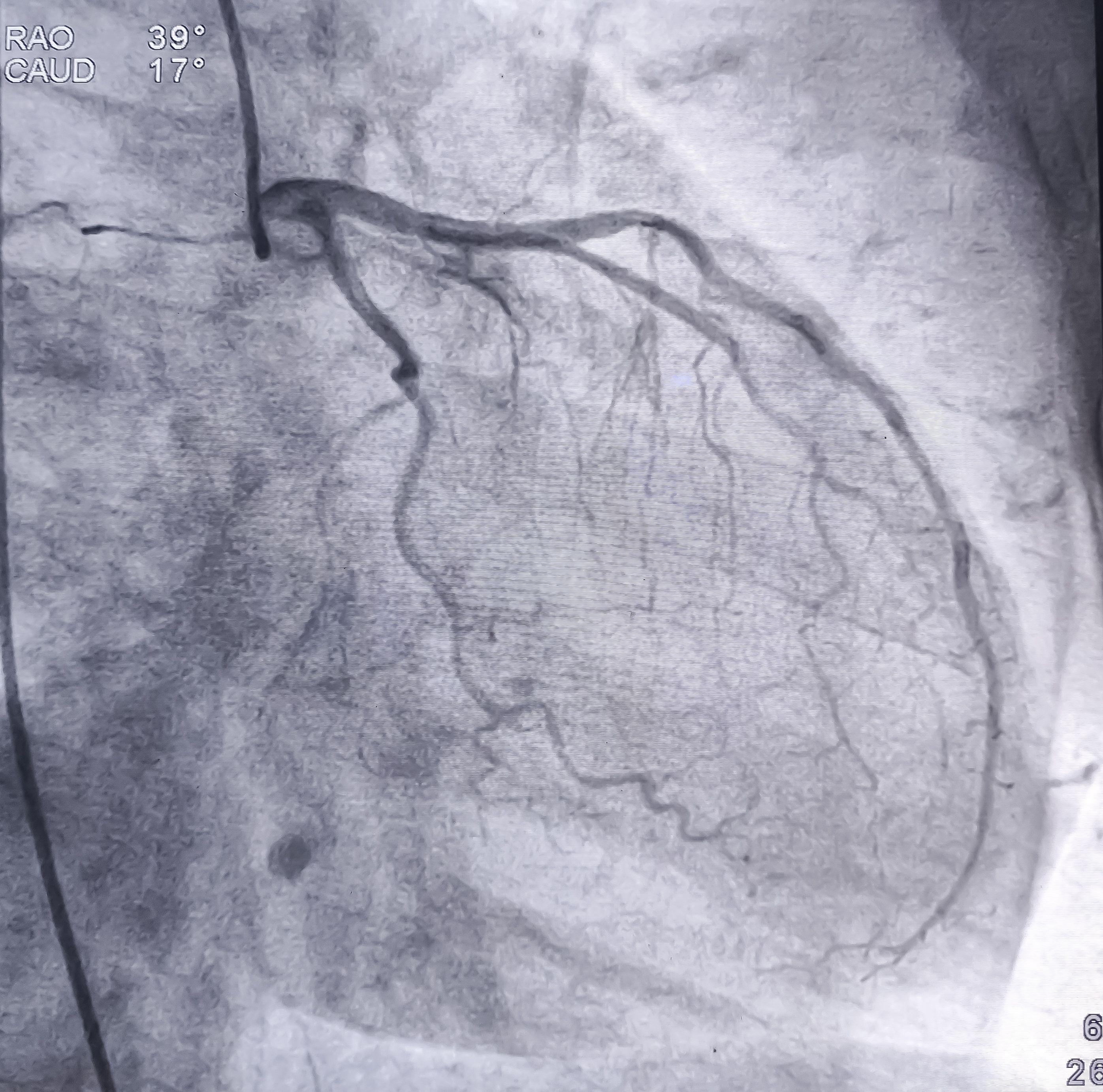 heart surgery
