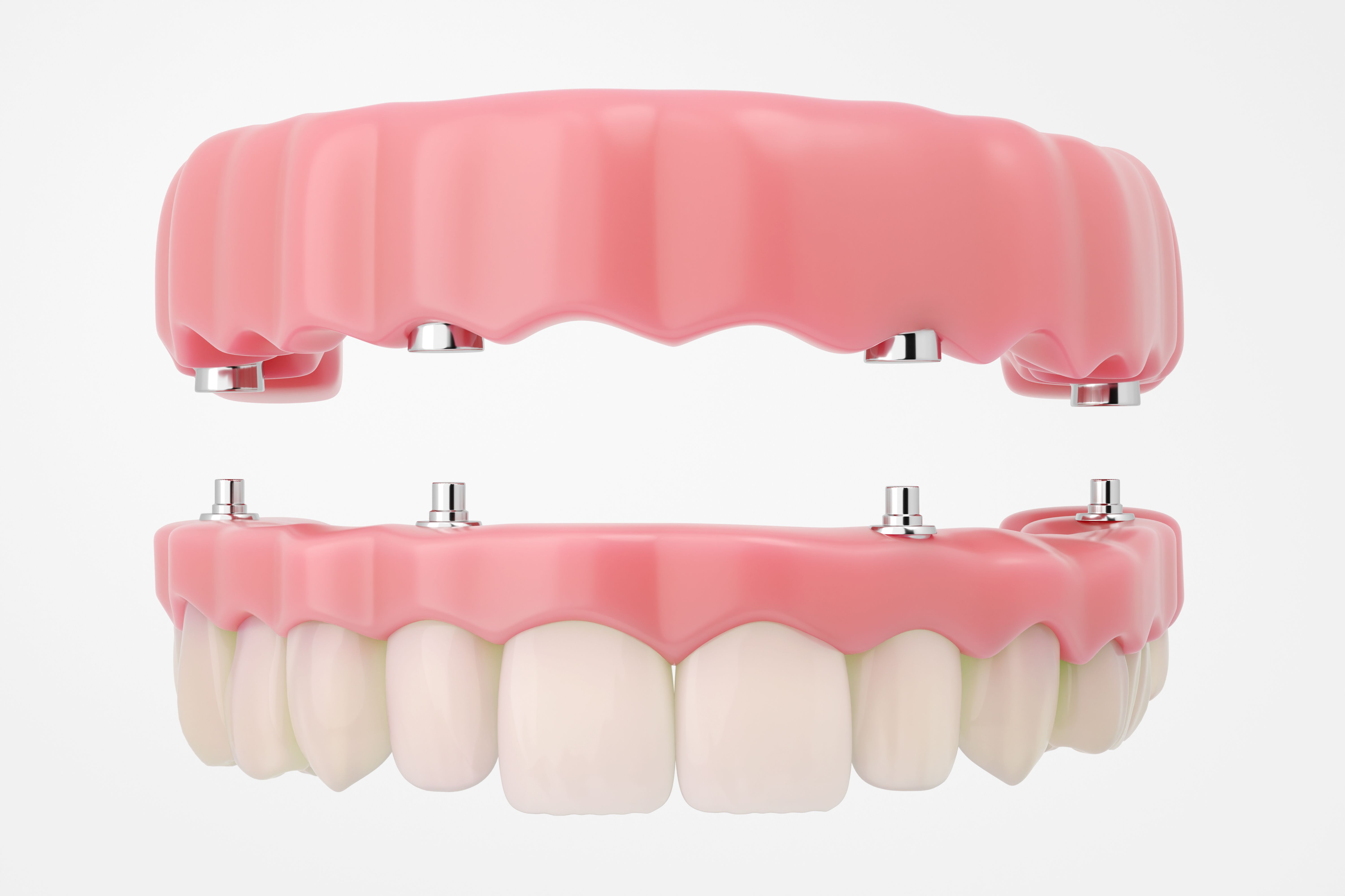 fixed dental prosthesis