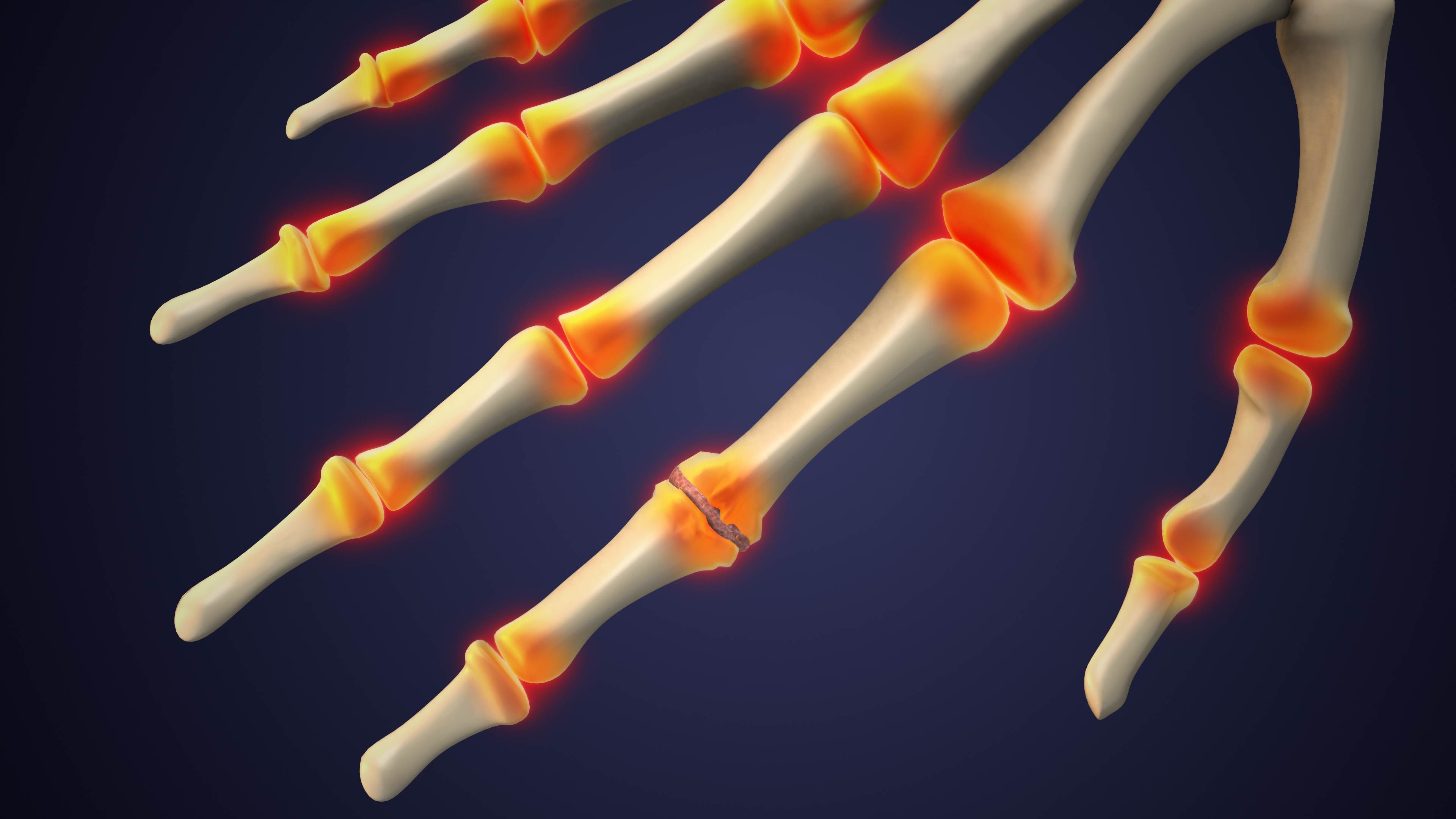 rheumatoid arthritis