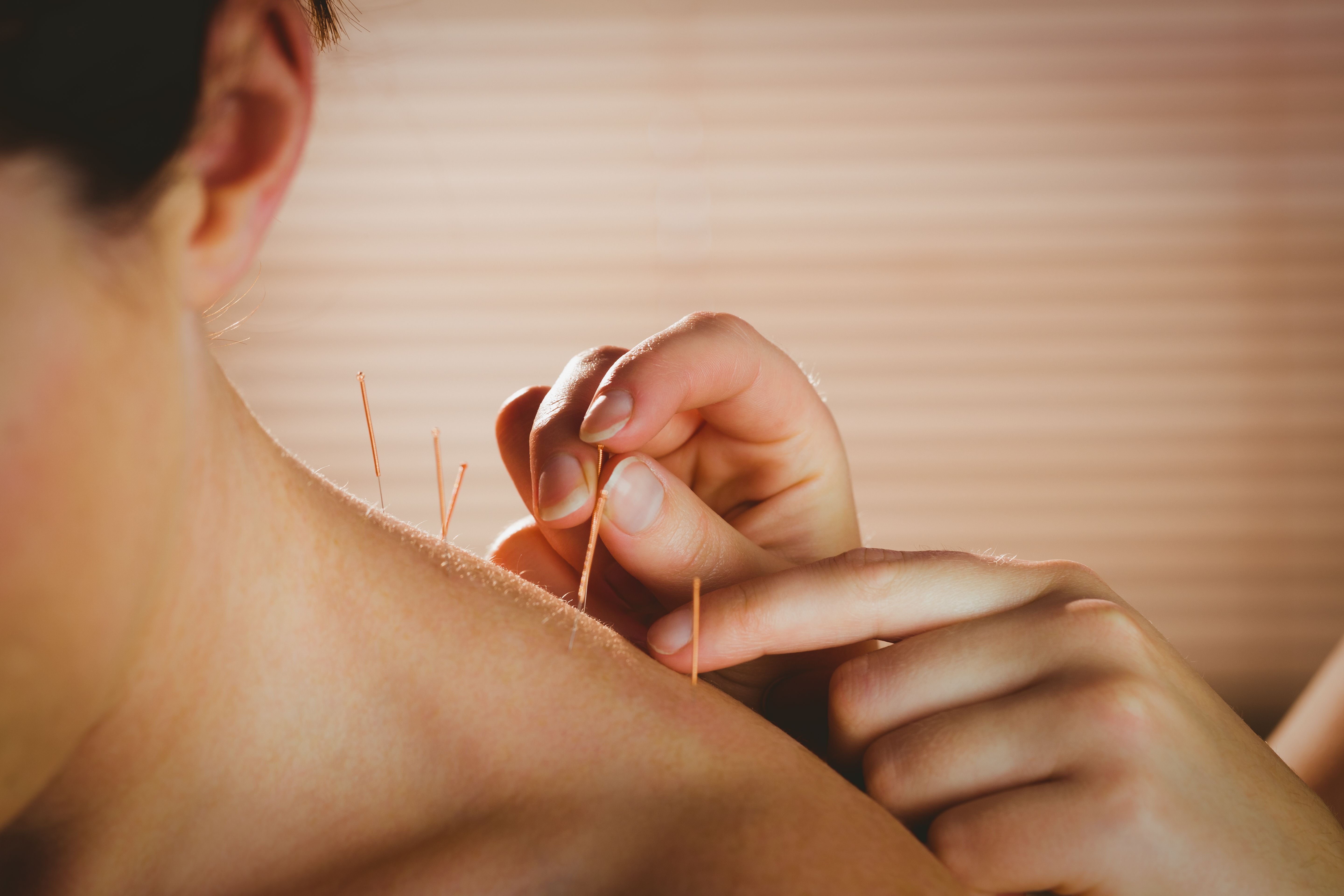 acupuncture treatment