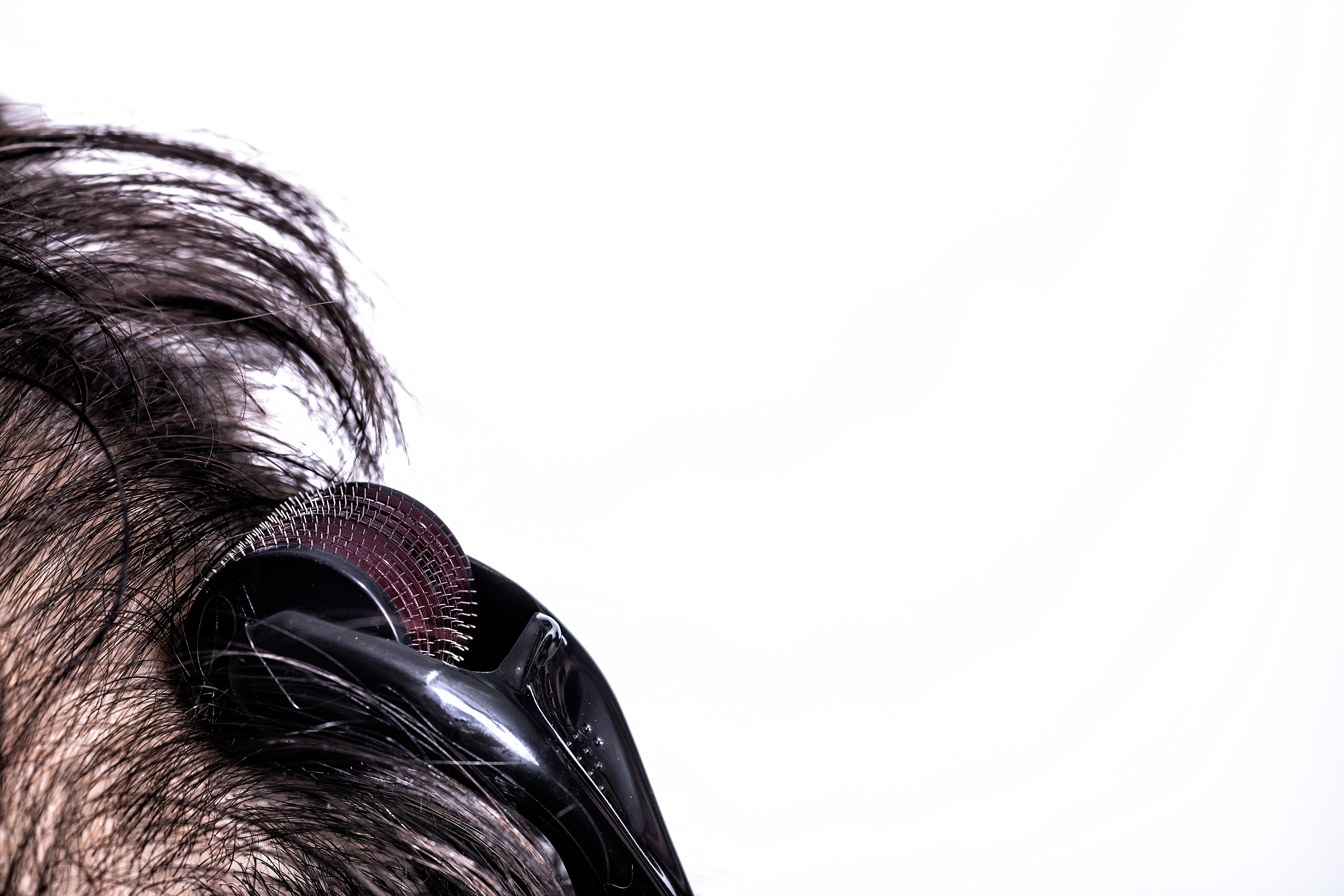 Microneedling hair loss treatment Microneedling hair loss treatment