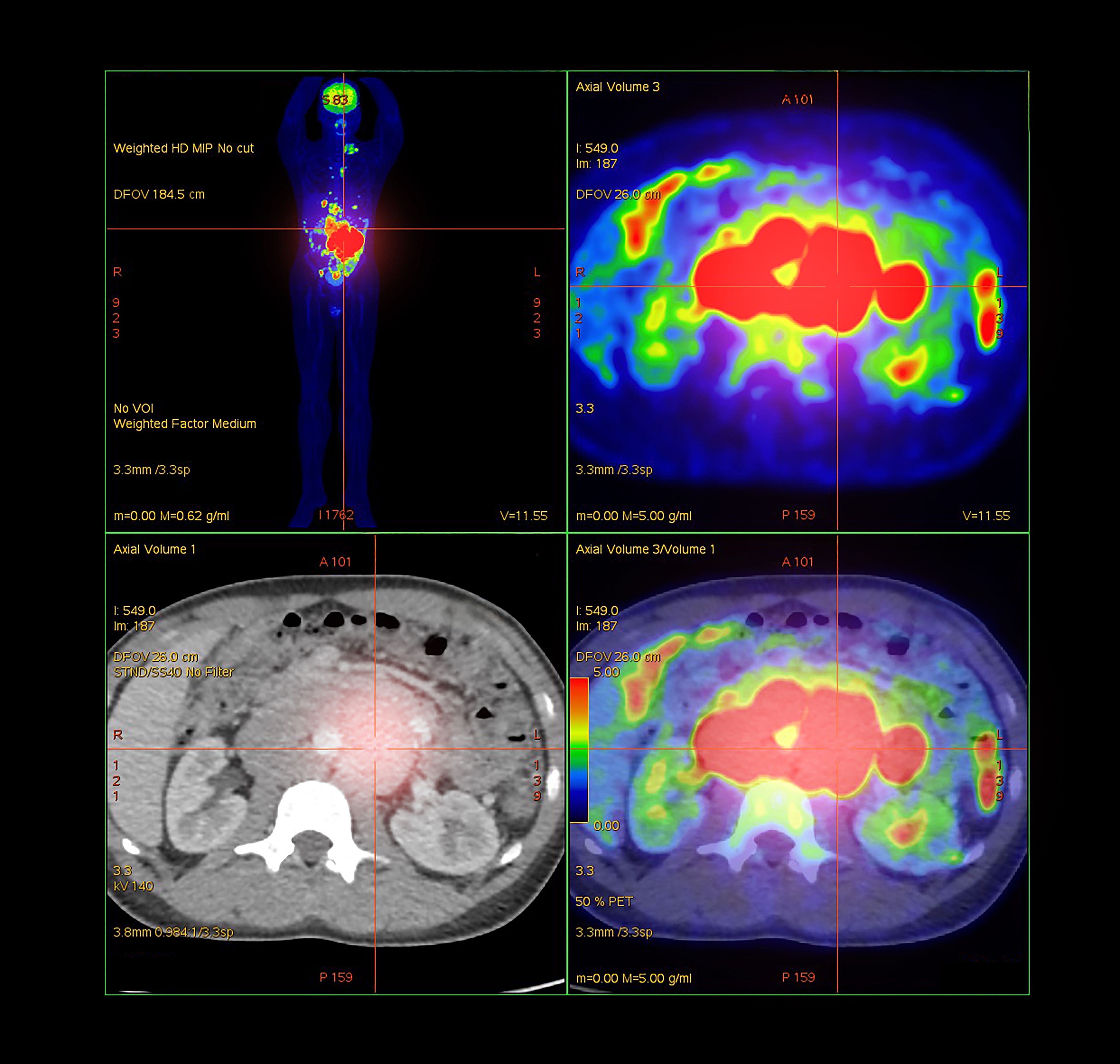 brain tumor diagnosis