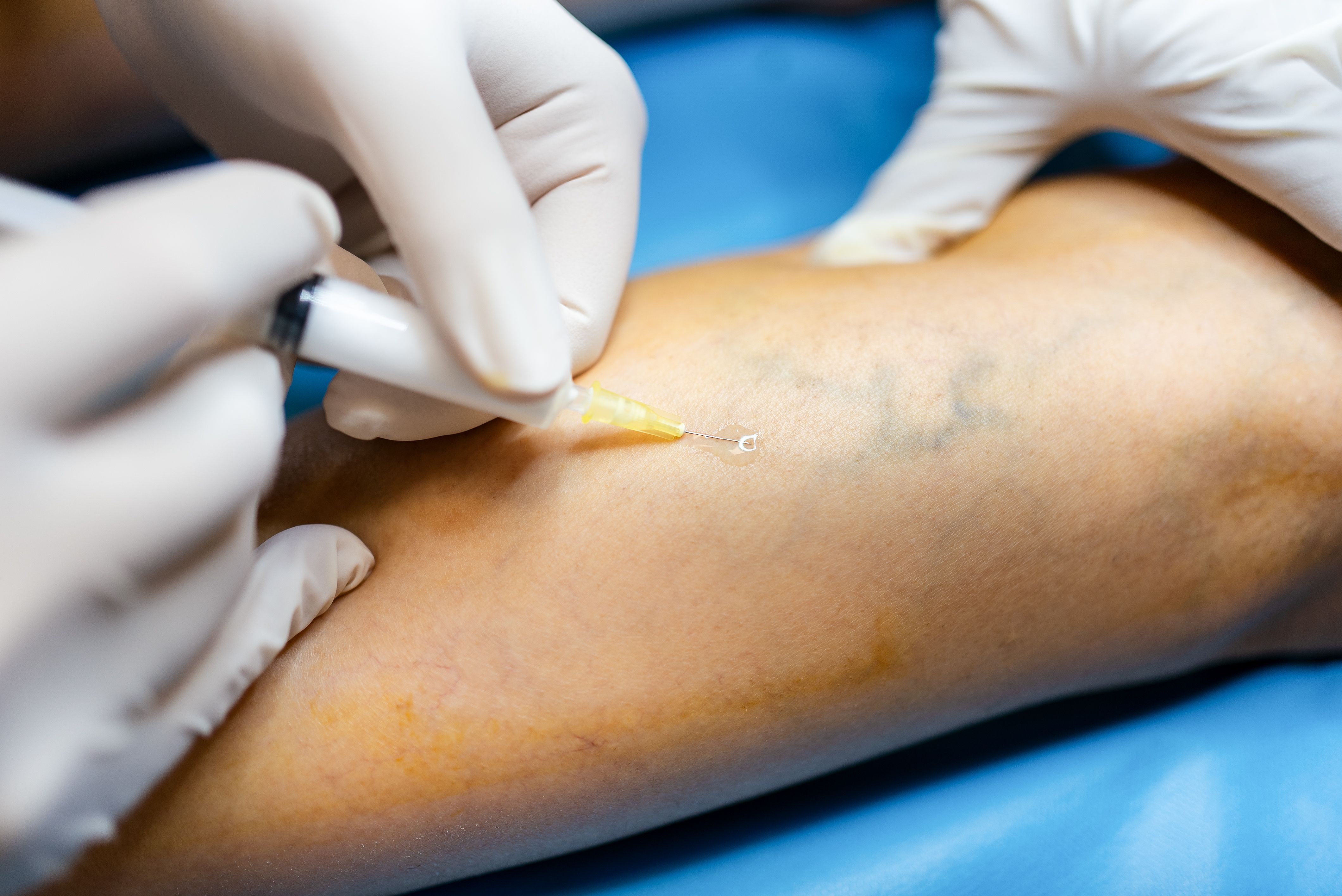 sclerotherapy procedure