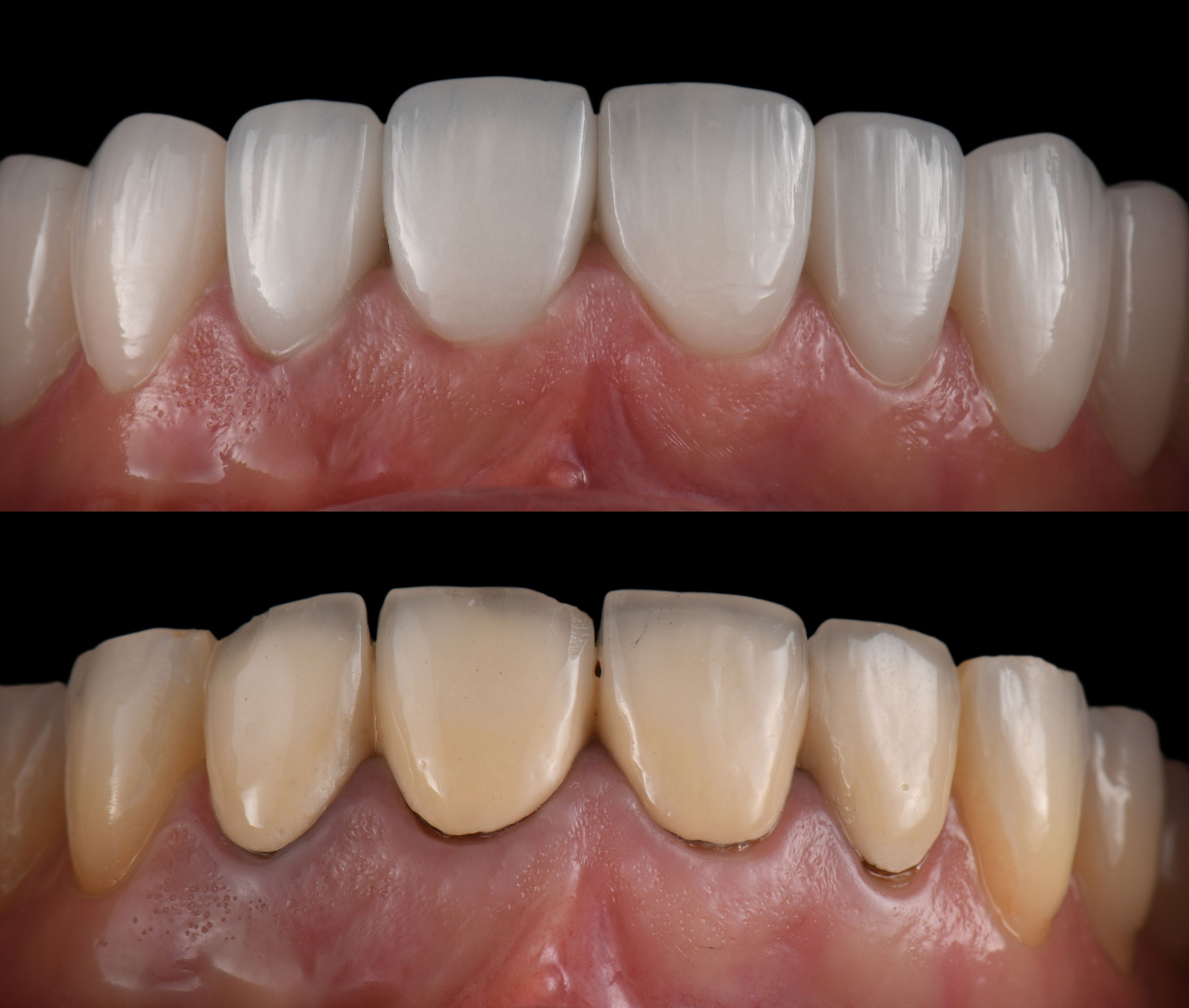 dental veneers