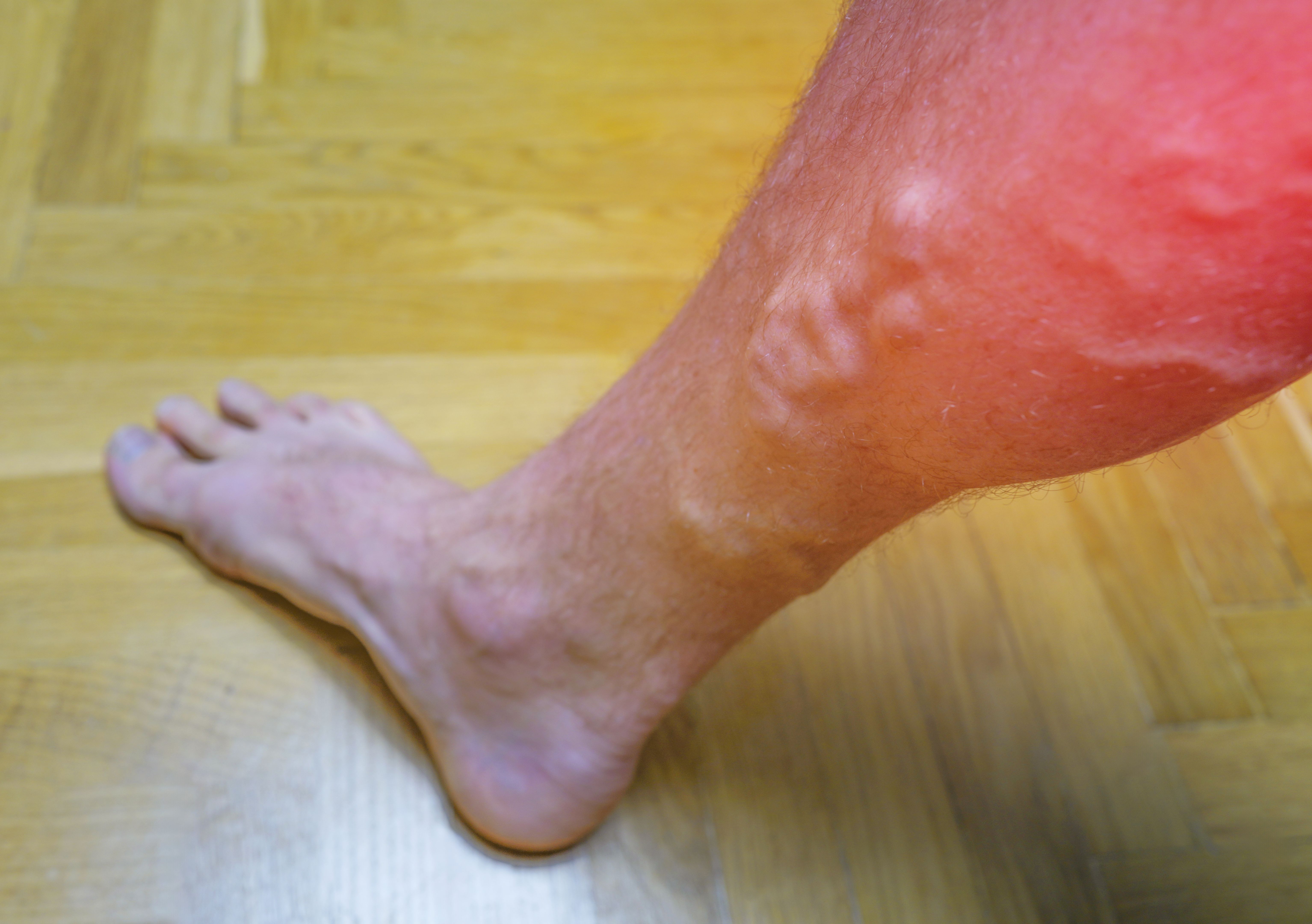 varicose veins