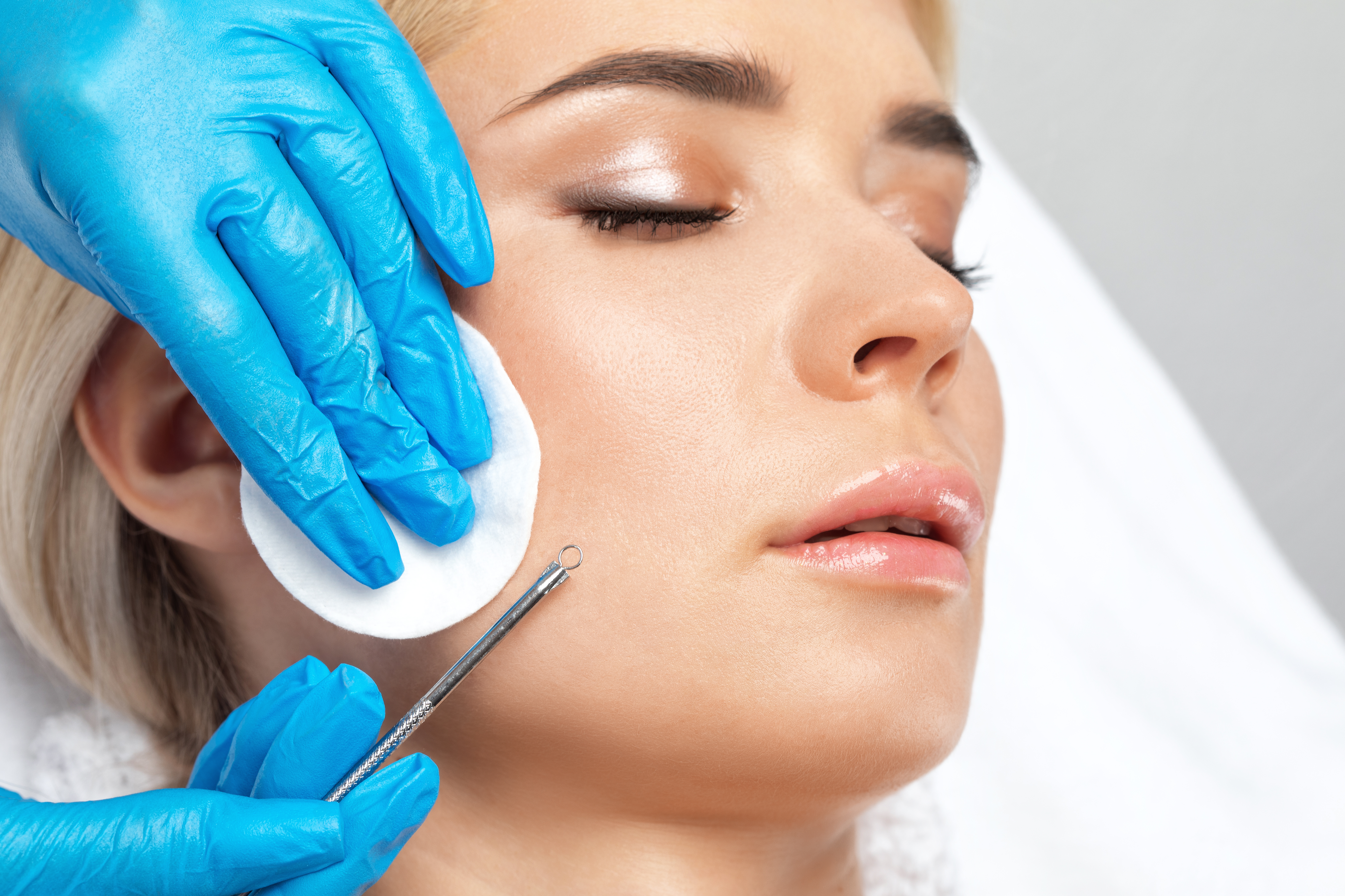 A procedure for cleansing the skin of the face from blackheads and acne. Cosmetologist treats problematic skin of a young woman's face in a beauty salon. Aesthetic cosmetology and makeup concept.