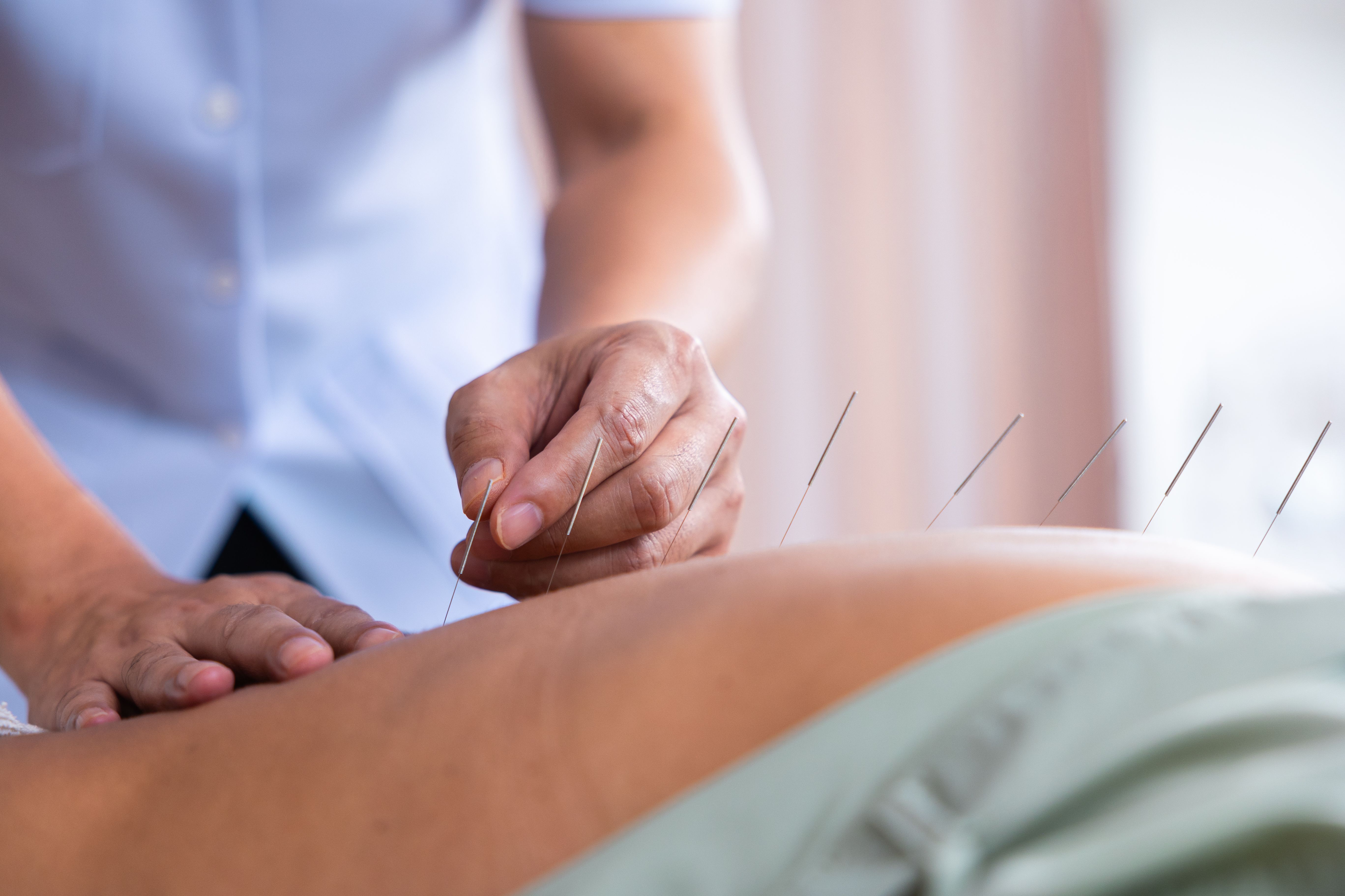 patient receiving acupuncture
