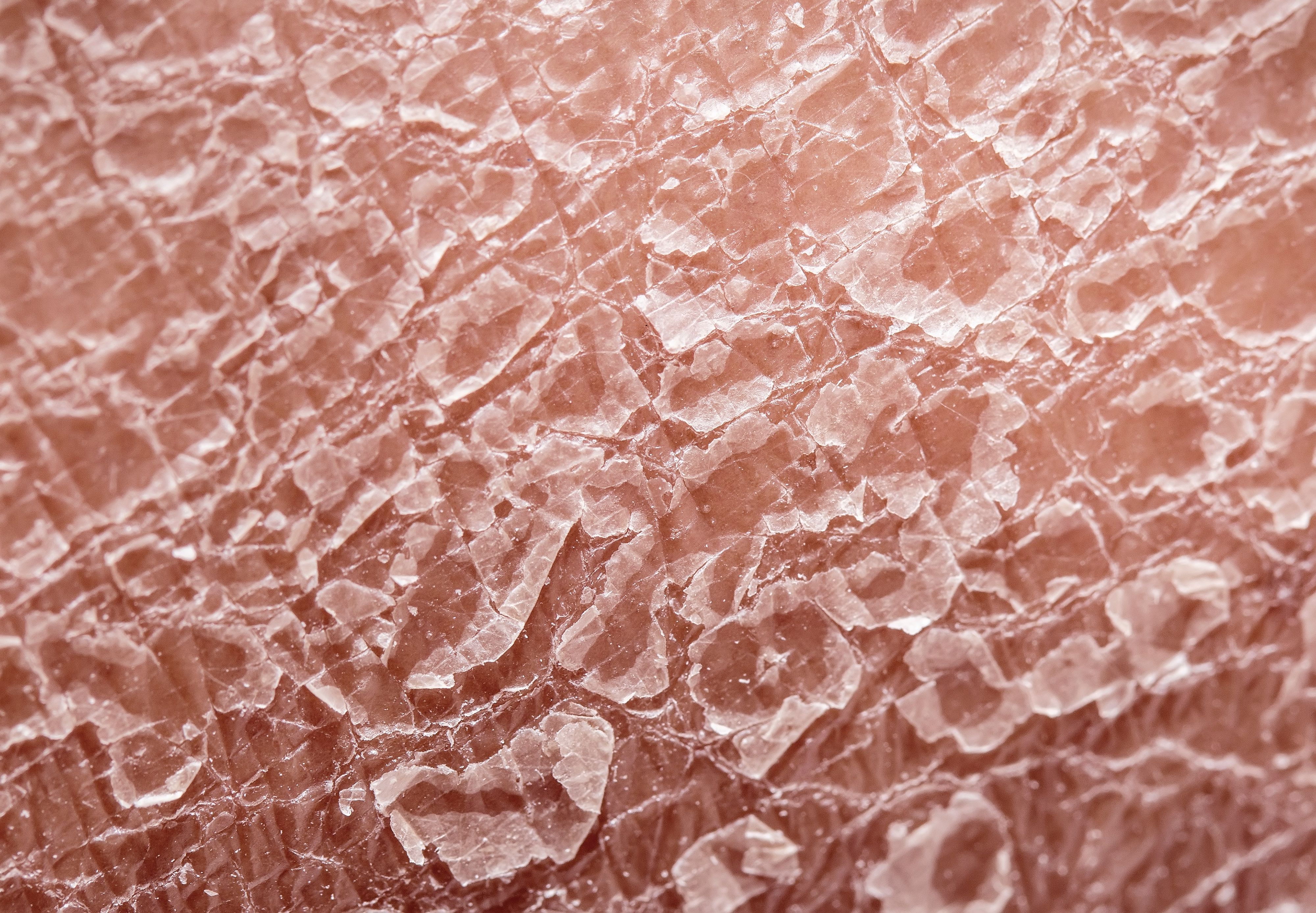 psoriasis skin