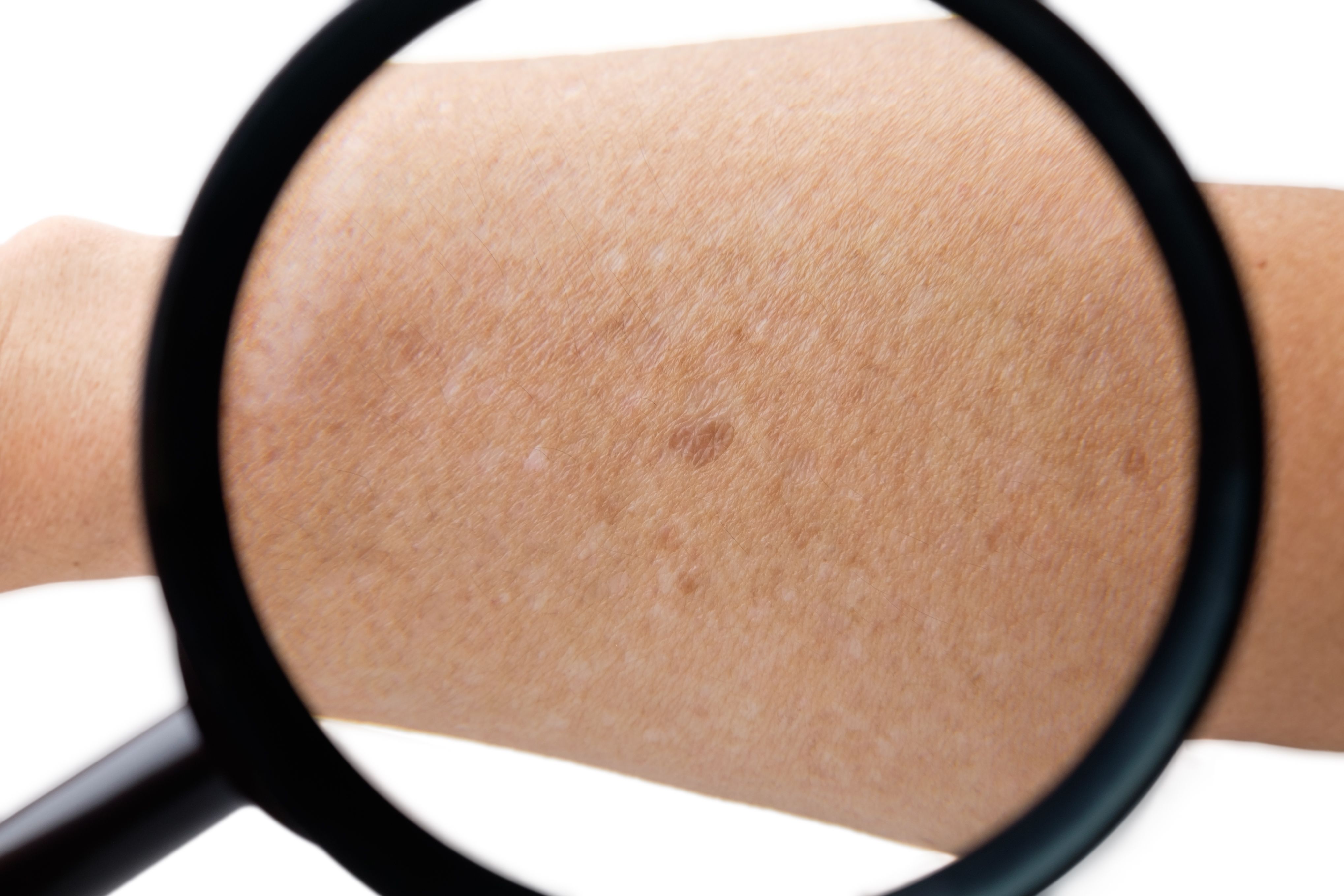 guttate psoriasis skin