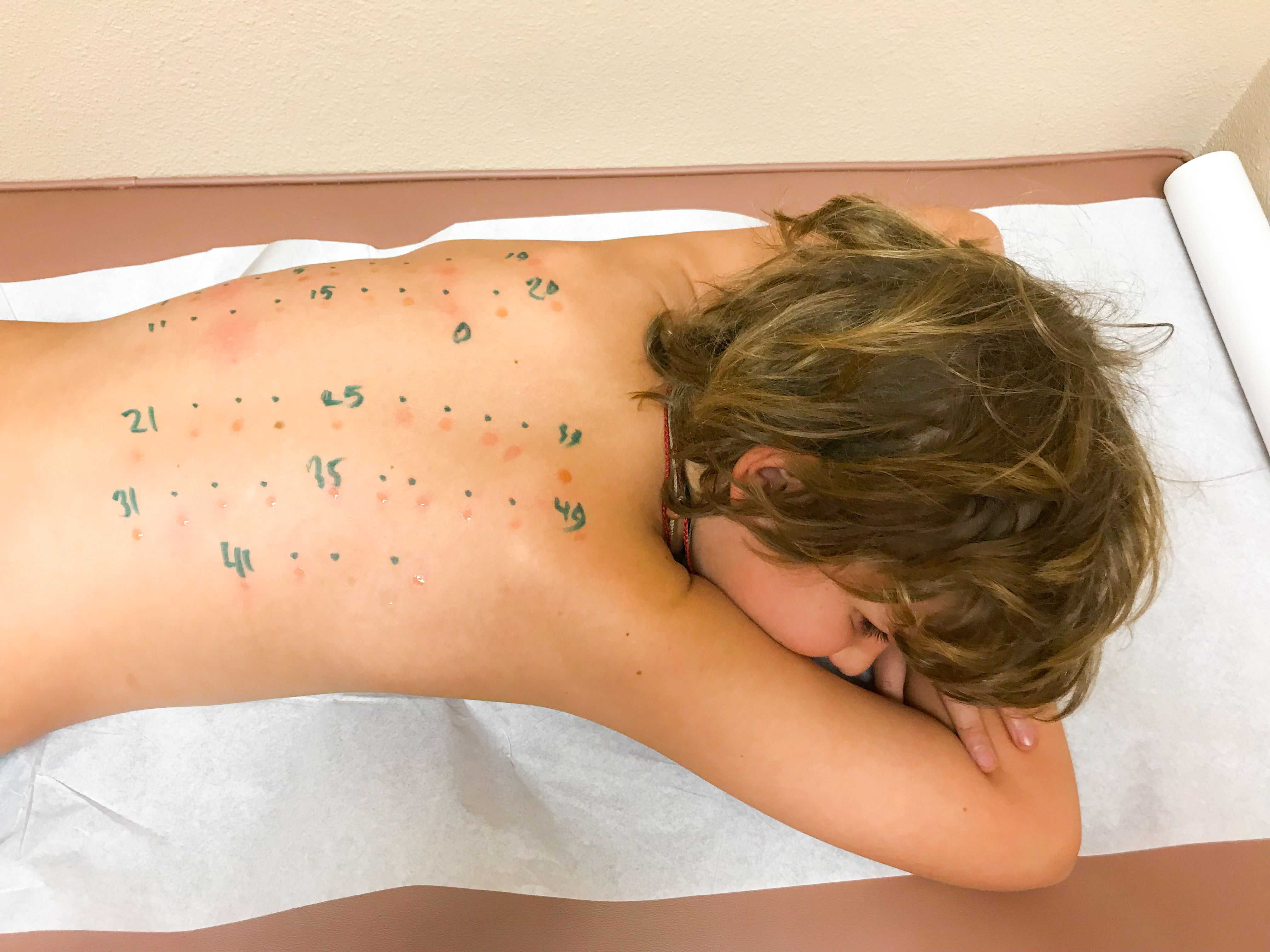 allergy testing