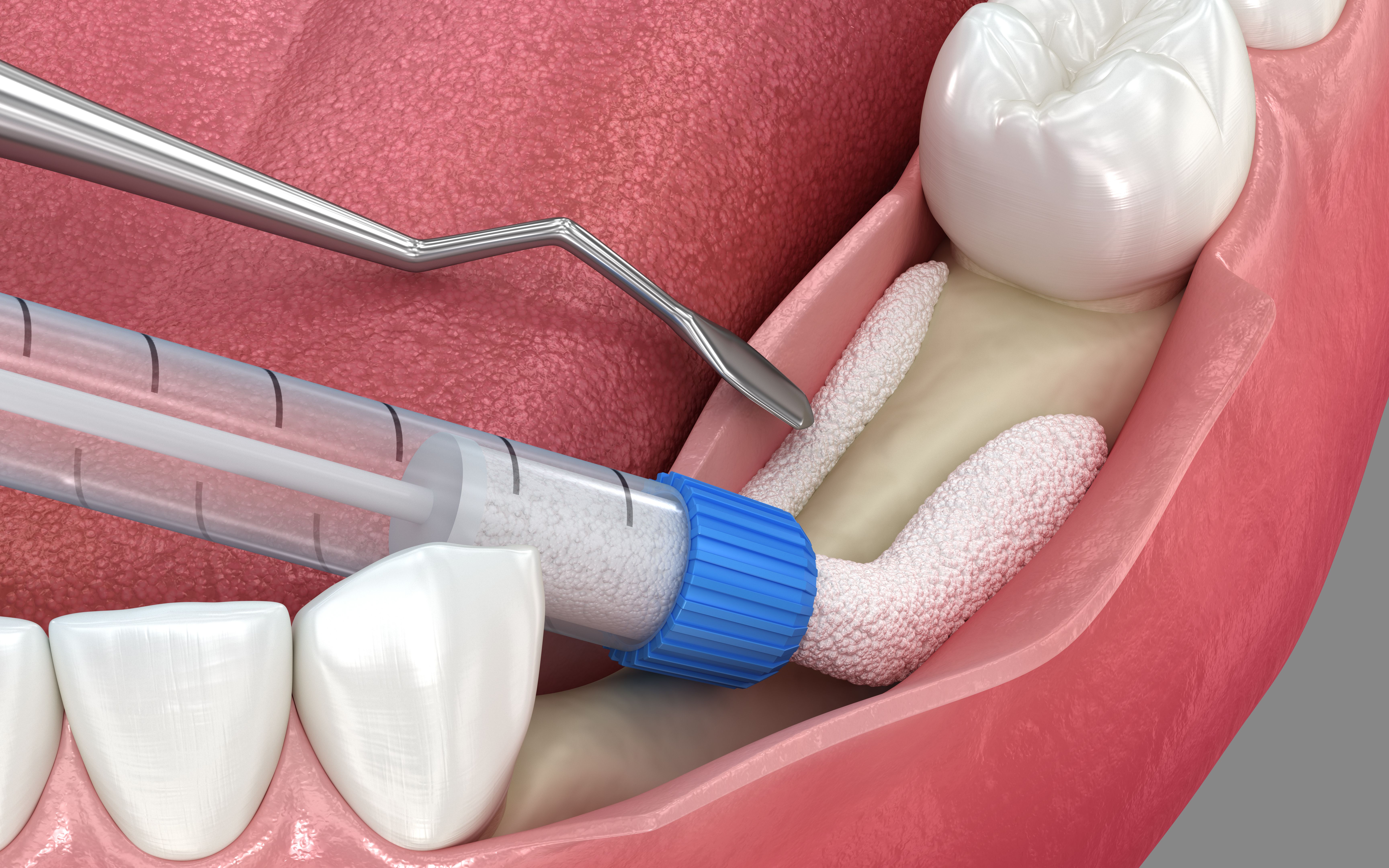 bone graft procedure