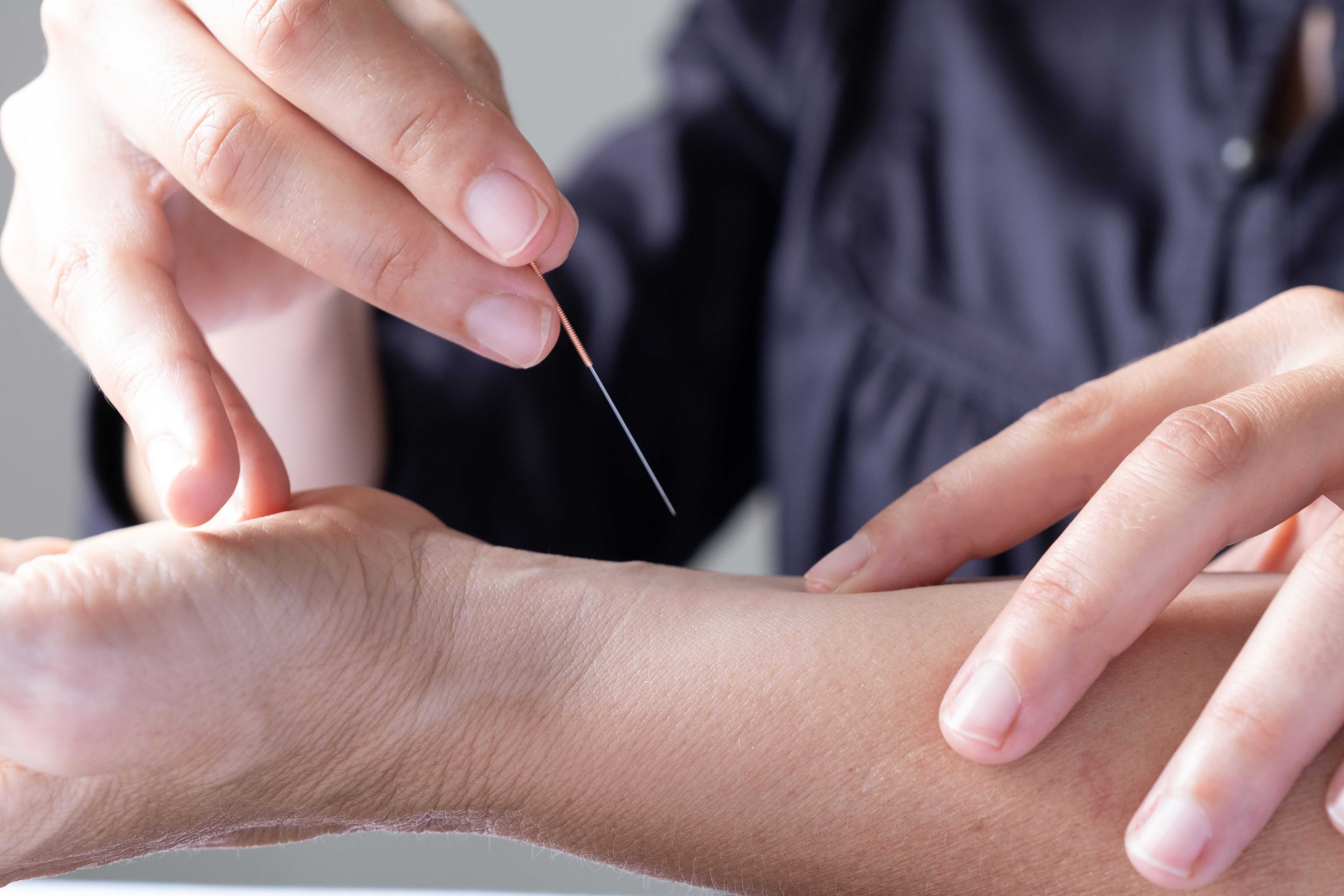 acupuncture session