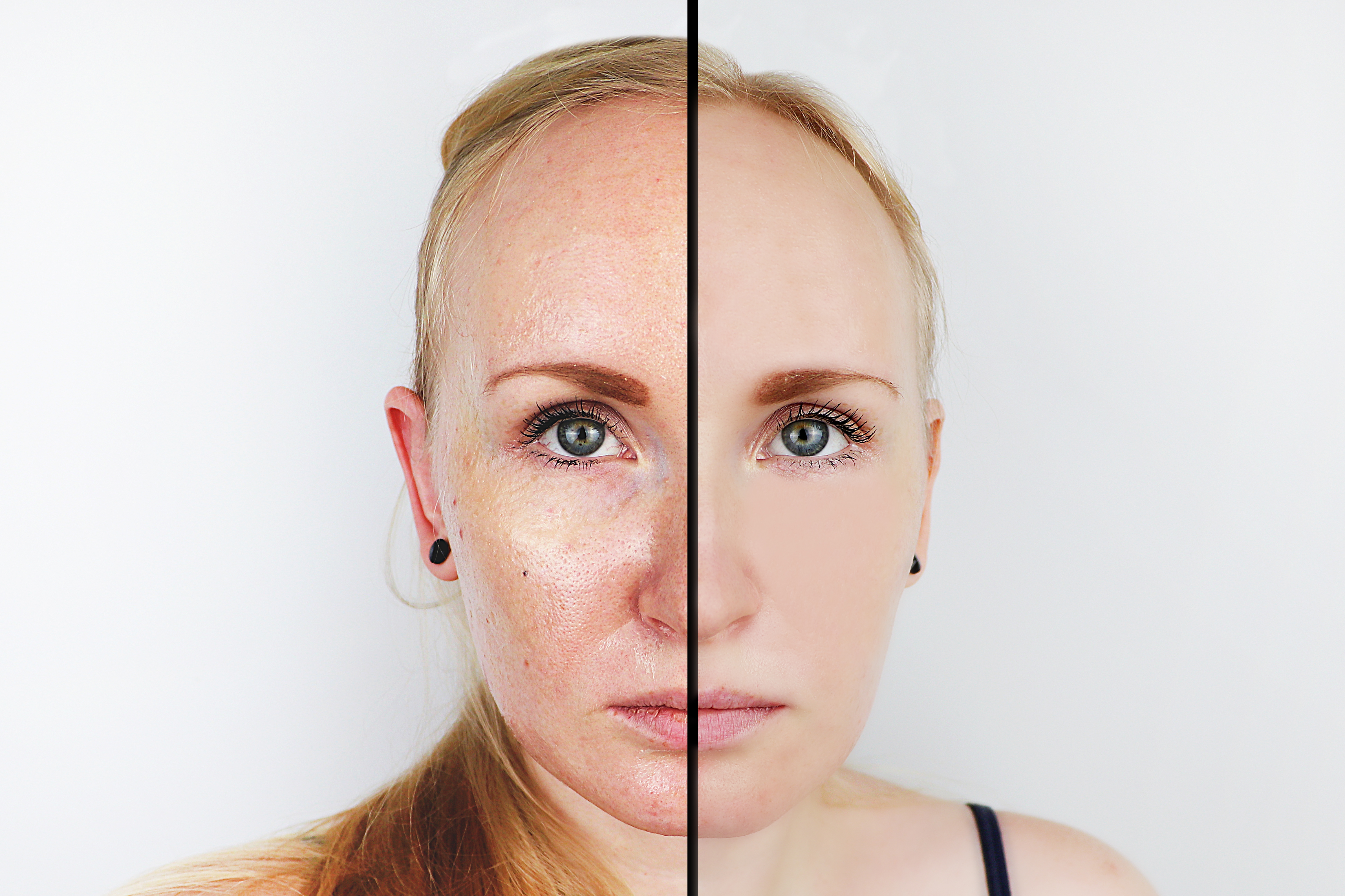 Oily skin and clear skin. Two photos before and after. Portrait of a girl with problem skin Oily skin and clear skin. Two photos before and after. Portrait of a girl with problem skin